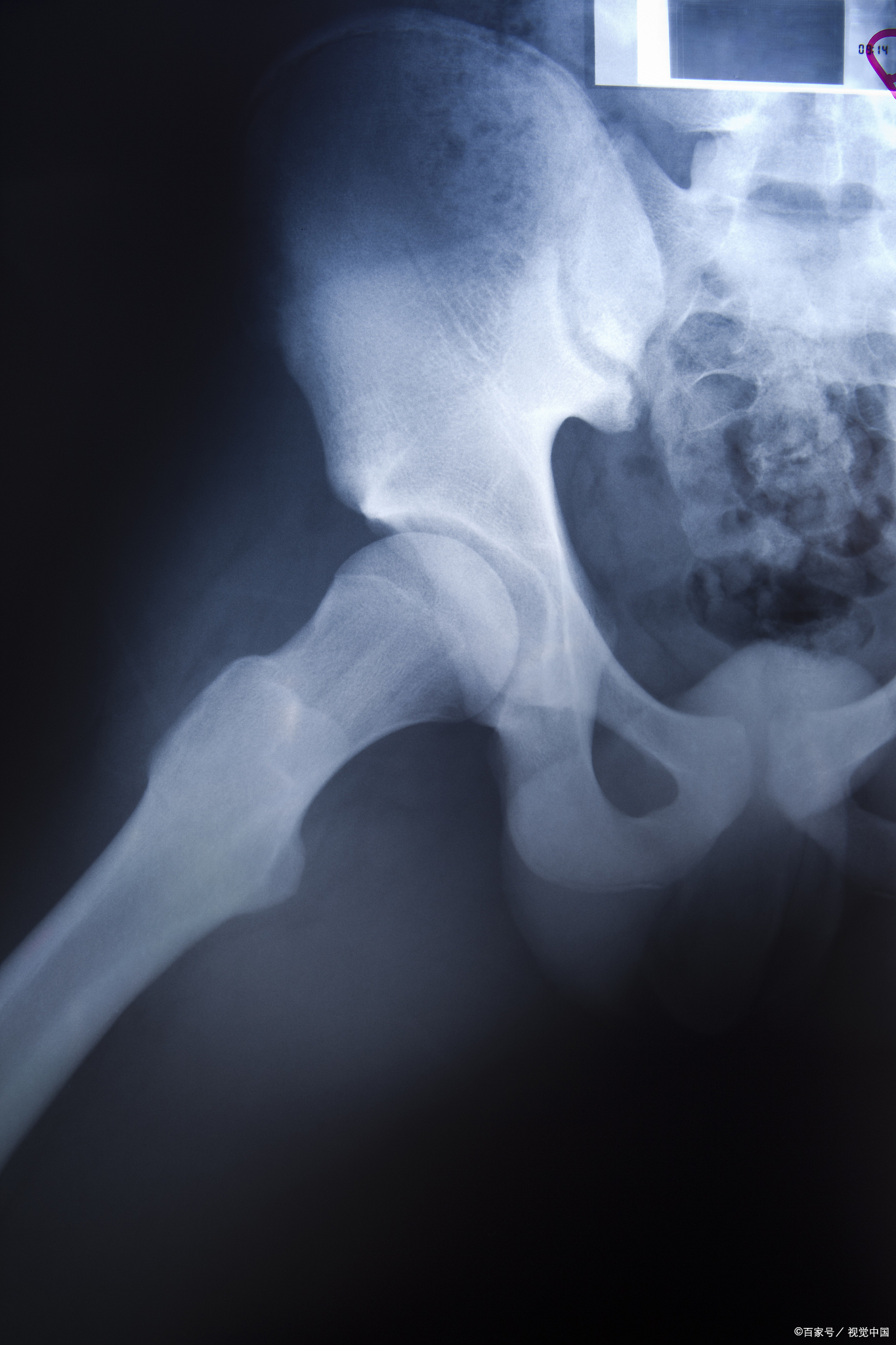 传统的双髋关节核磁共振虽然能提供一定的信息,但其分辨率和精确度