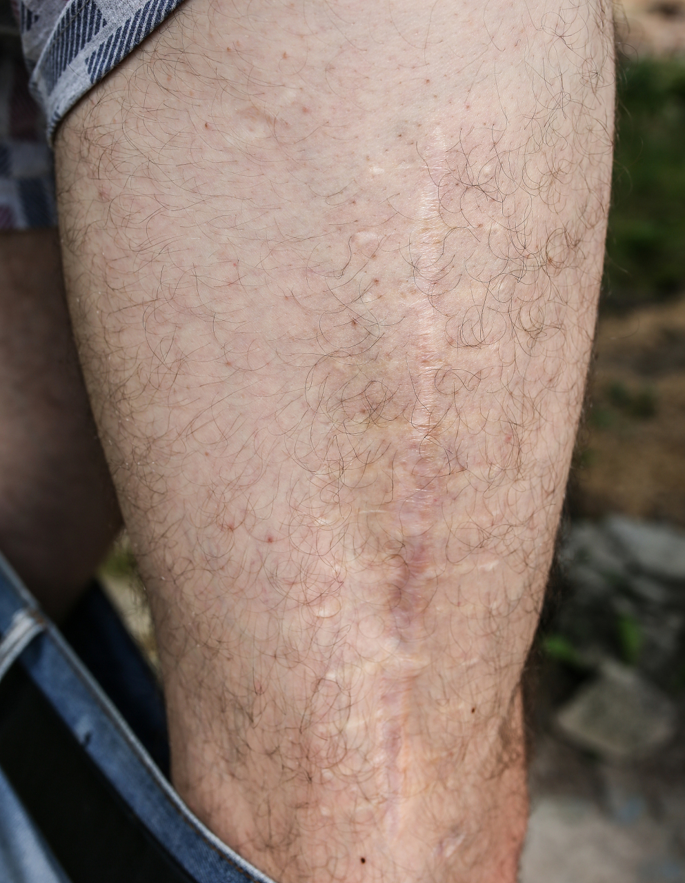 医美# #皮肤管理课堂#  膨胀纹,也被称为妊娠纹或皮肤撕裂纹,通常