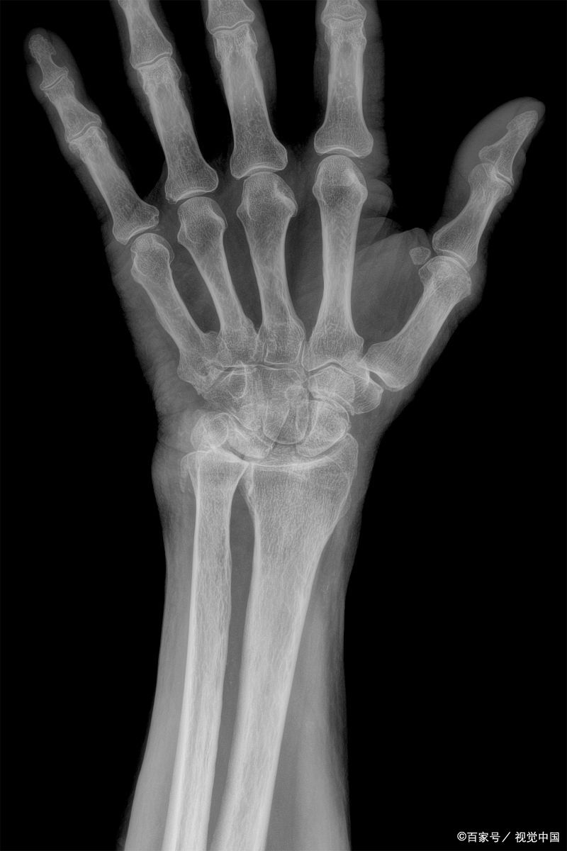 转发提醒:5岁以上孩子出现身高异常,务必尽早到正规医允滞 x光正常