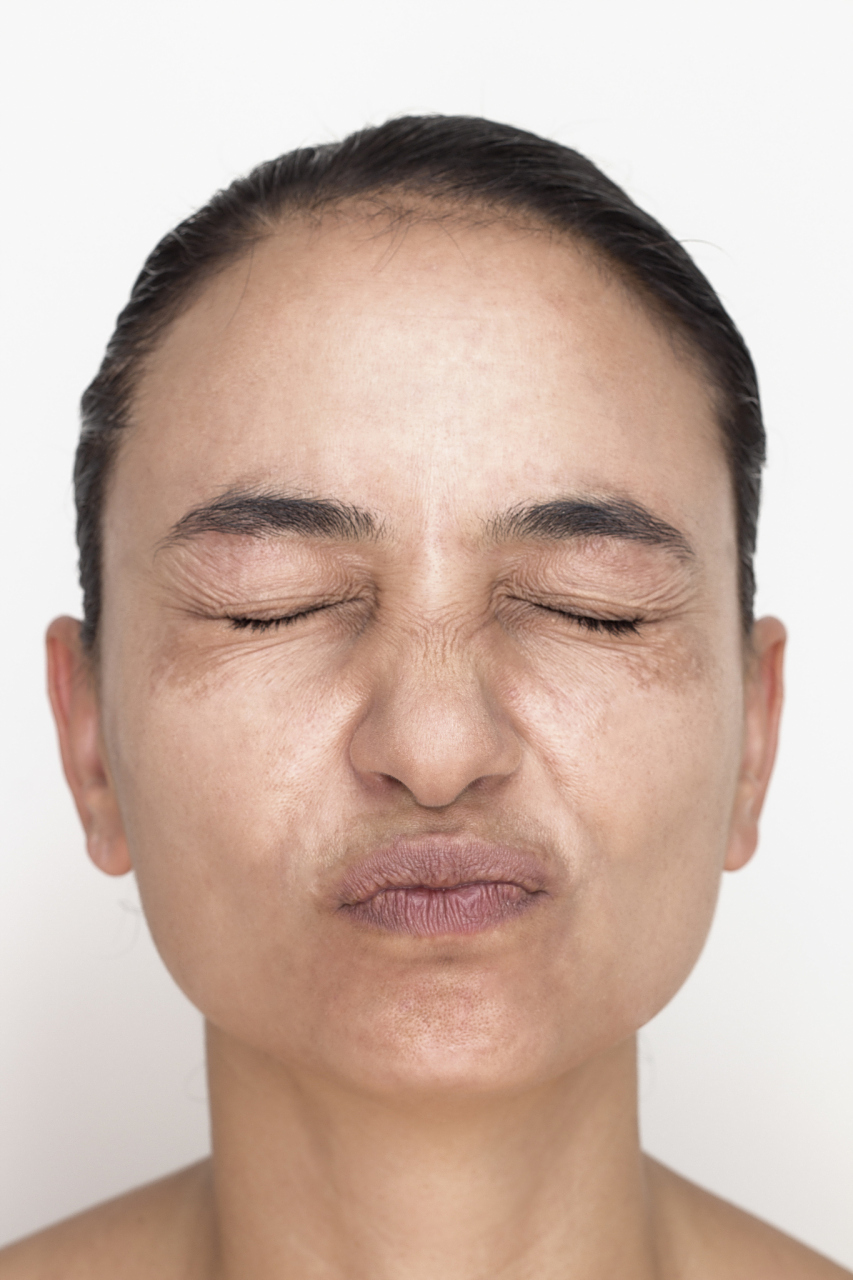 鼻横纹是一种常见的面部皱纹,通常出现在鼻子两侧的皮肤上.