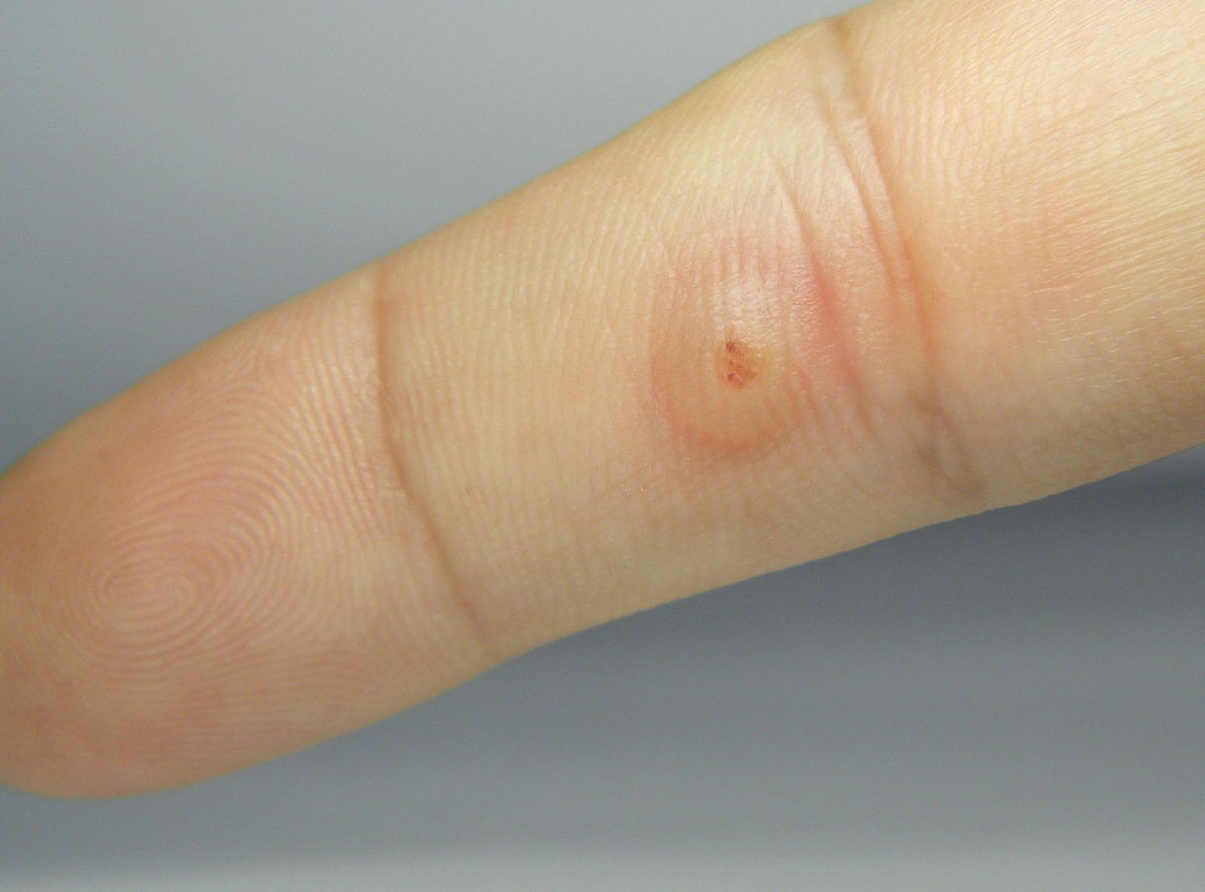 下面长了小疙瘩,竟是感染了hpv?