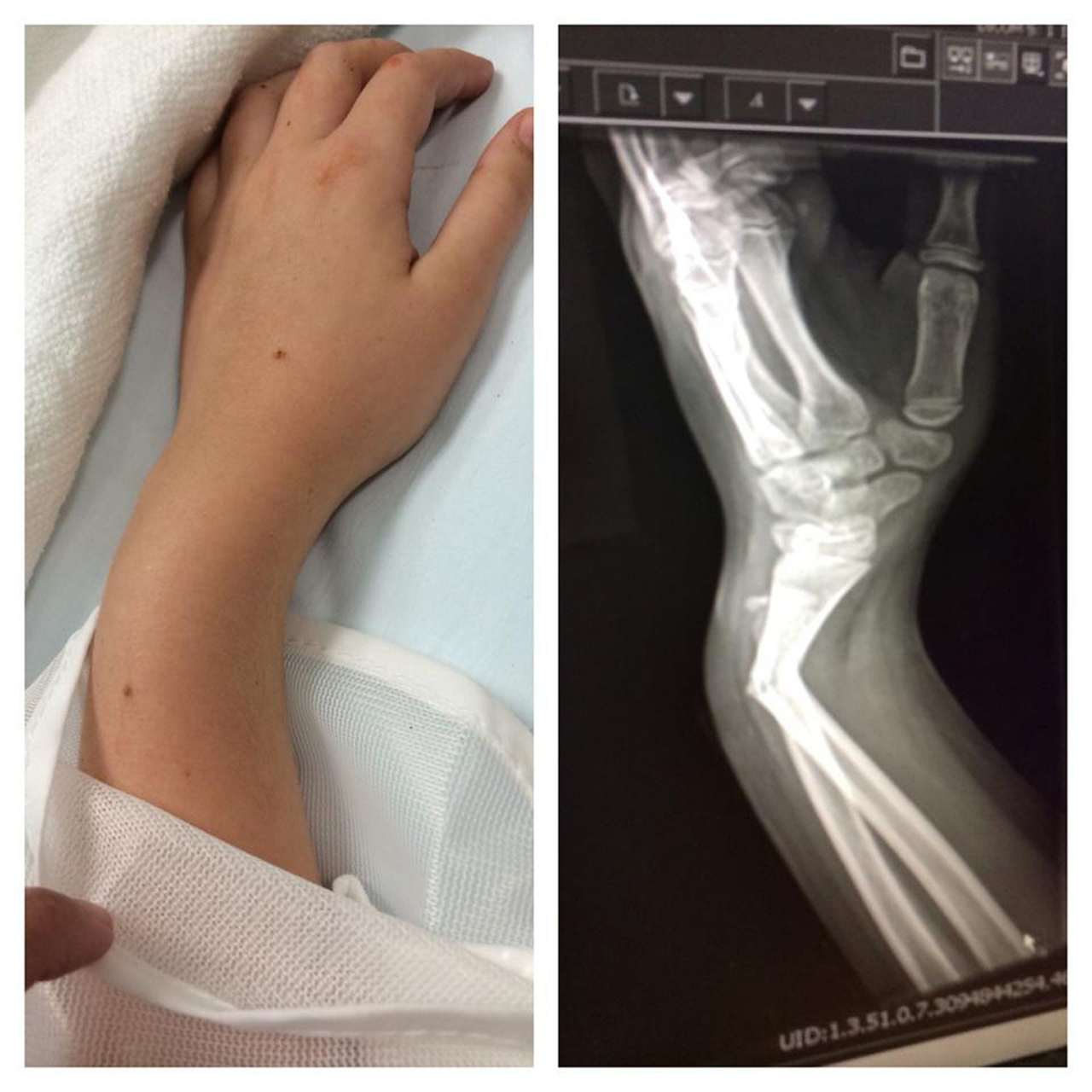 骨折后骨痂形成但负重仍痛,因骨痂非正常骨质,强度不足,受力易致疼痛.