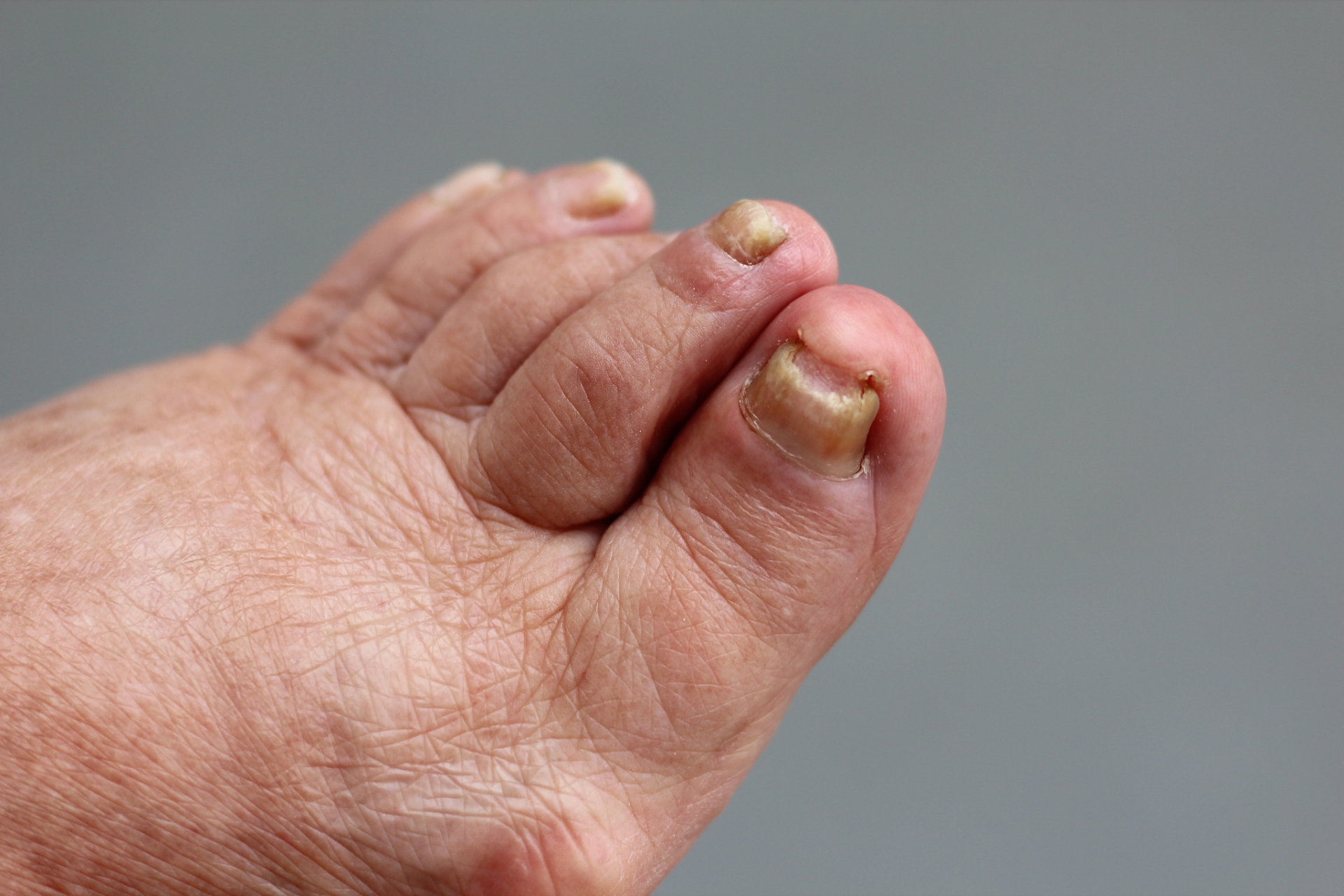 指甲银屑病是一种常见的慢性皮肤疾病,其主要特征是指甲出现异常的