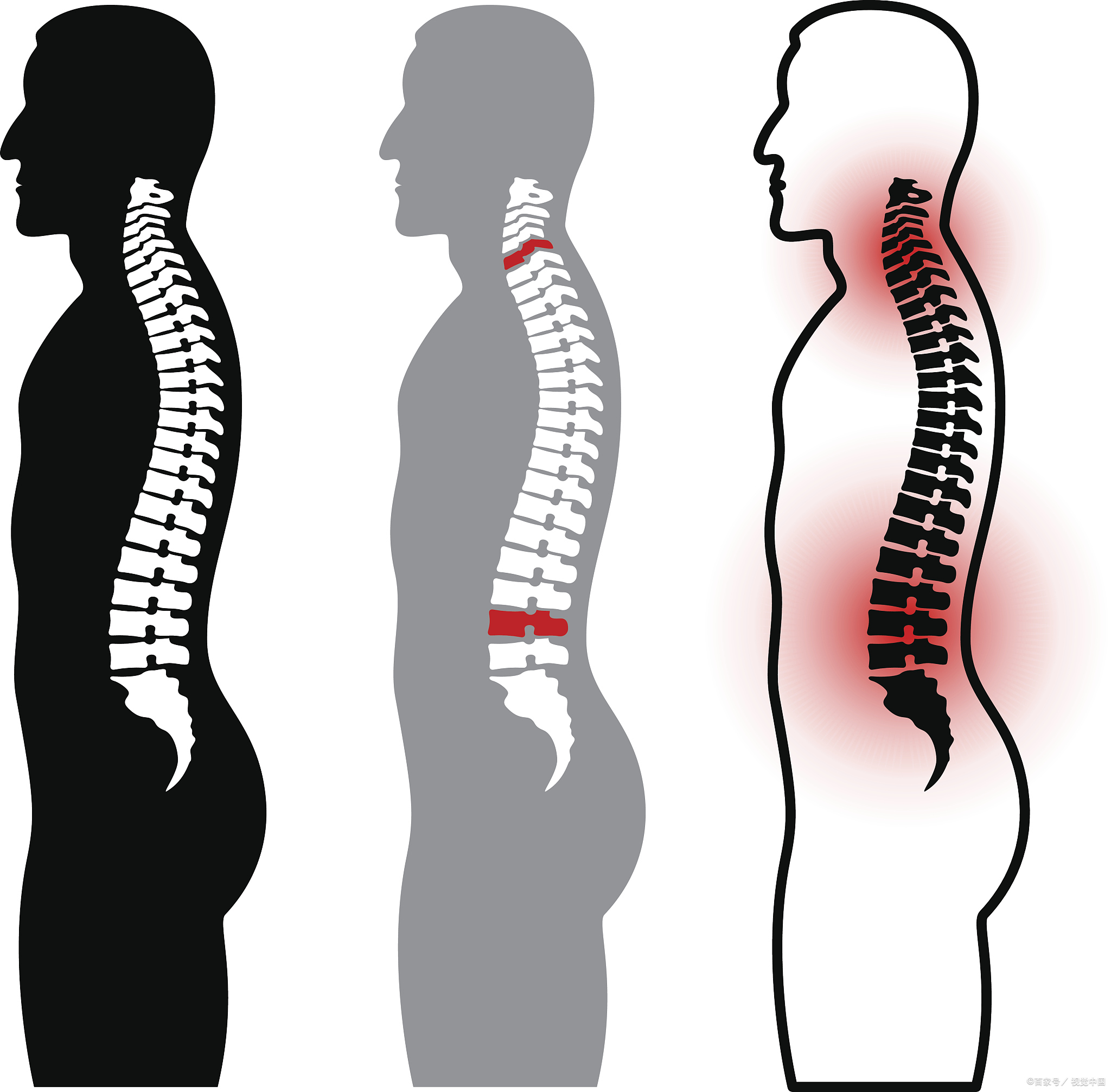 后背脊柱左侧肌肉鼓包图片