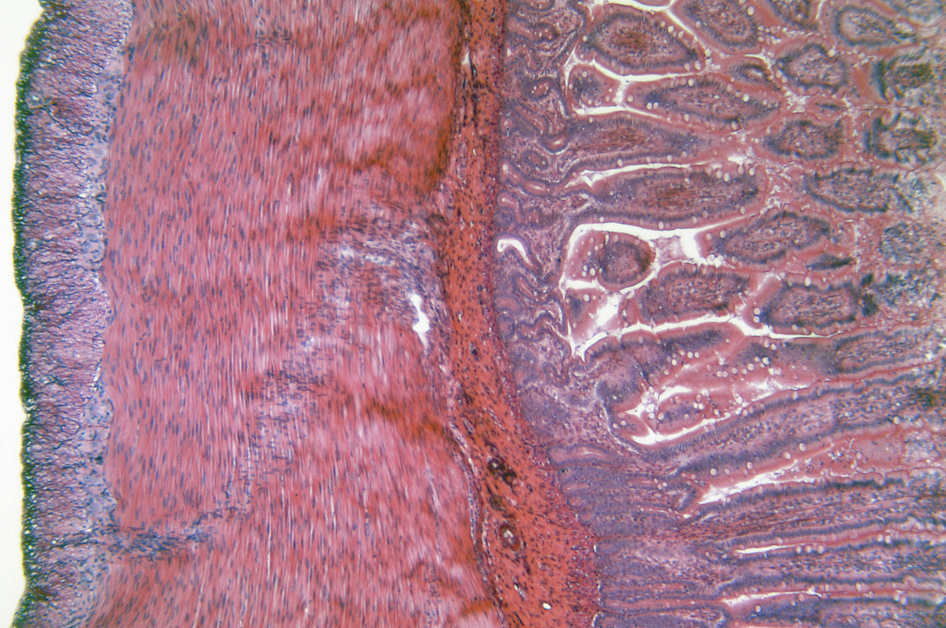 横纹肌肉瘤早期图片图片