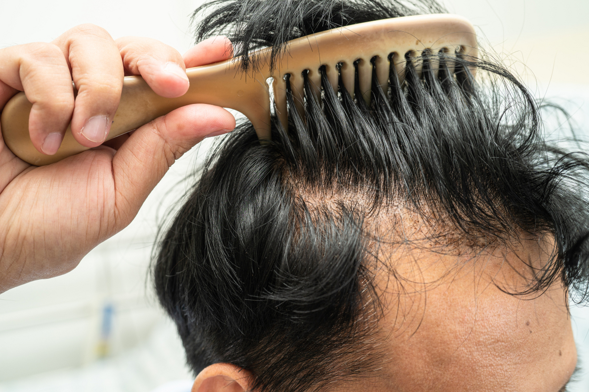 m型脱发也称为男性脱发,是男性雄激素性脱发中最常见的的一种敛床
