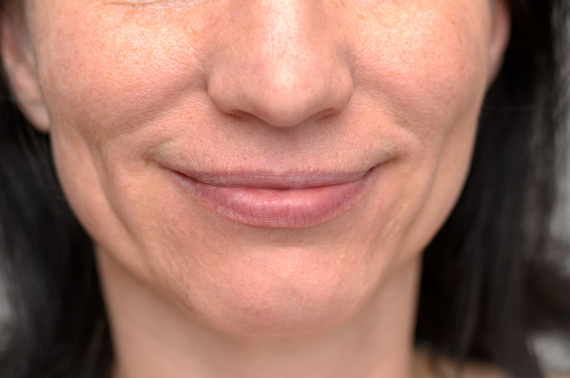 除皱针主要是用来去除鱼尾纹,额头纹,法令纹等面部皱纹,同样对口周纹