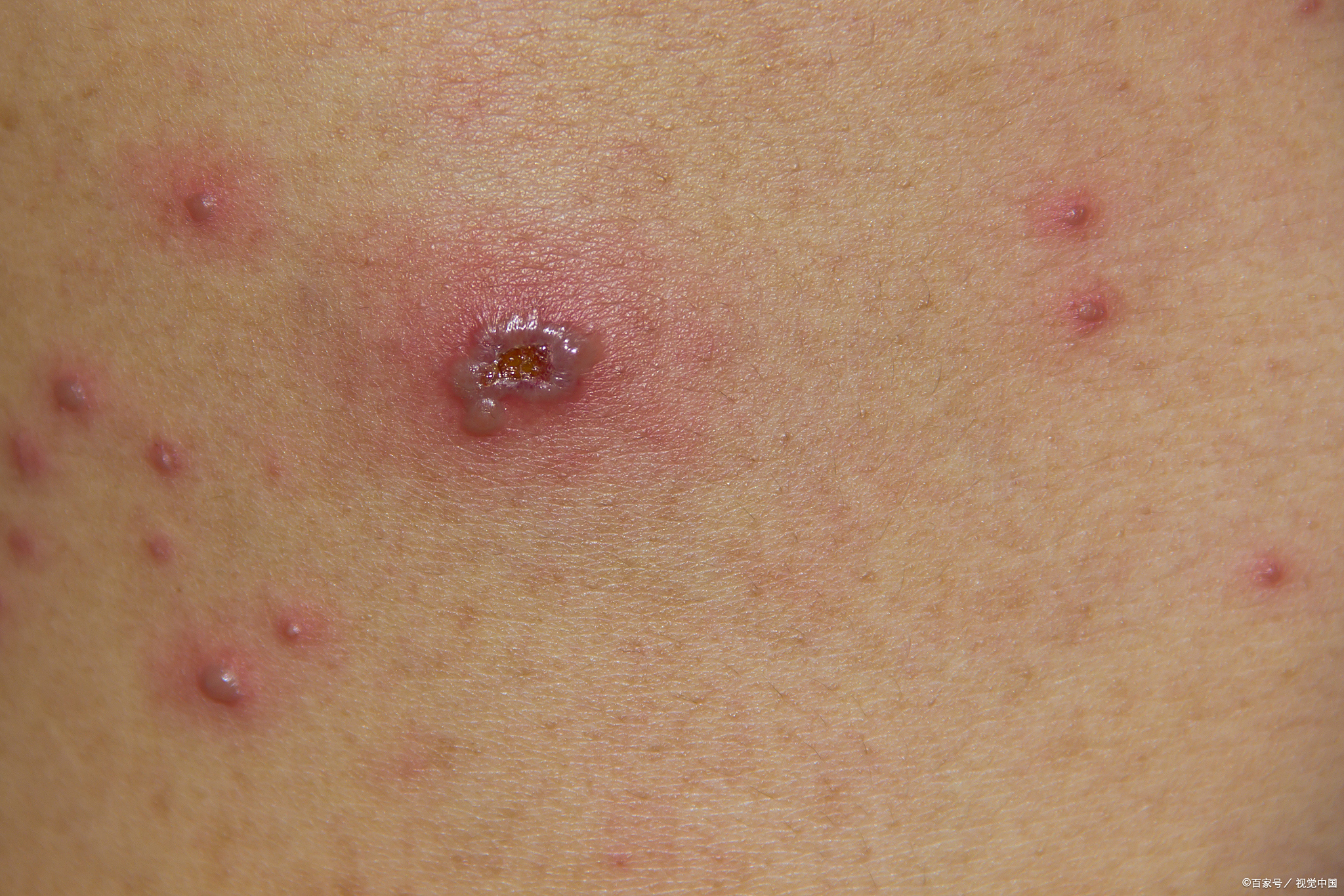 尖锐湿疣初期可能像皮肤上的"小疙瘩"一样毫无