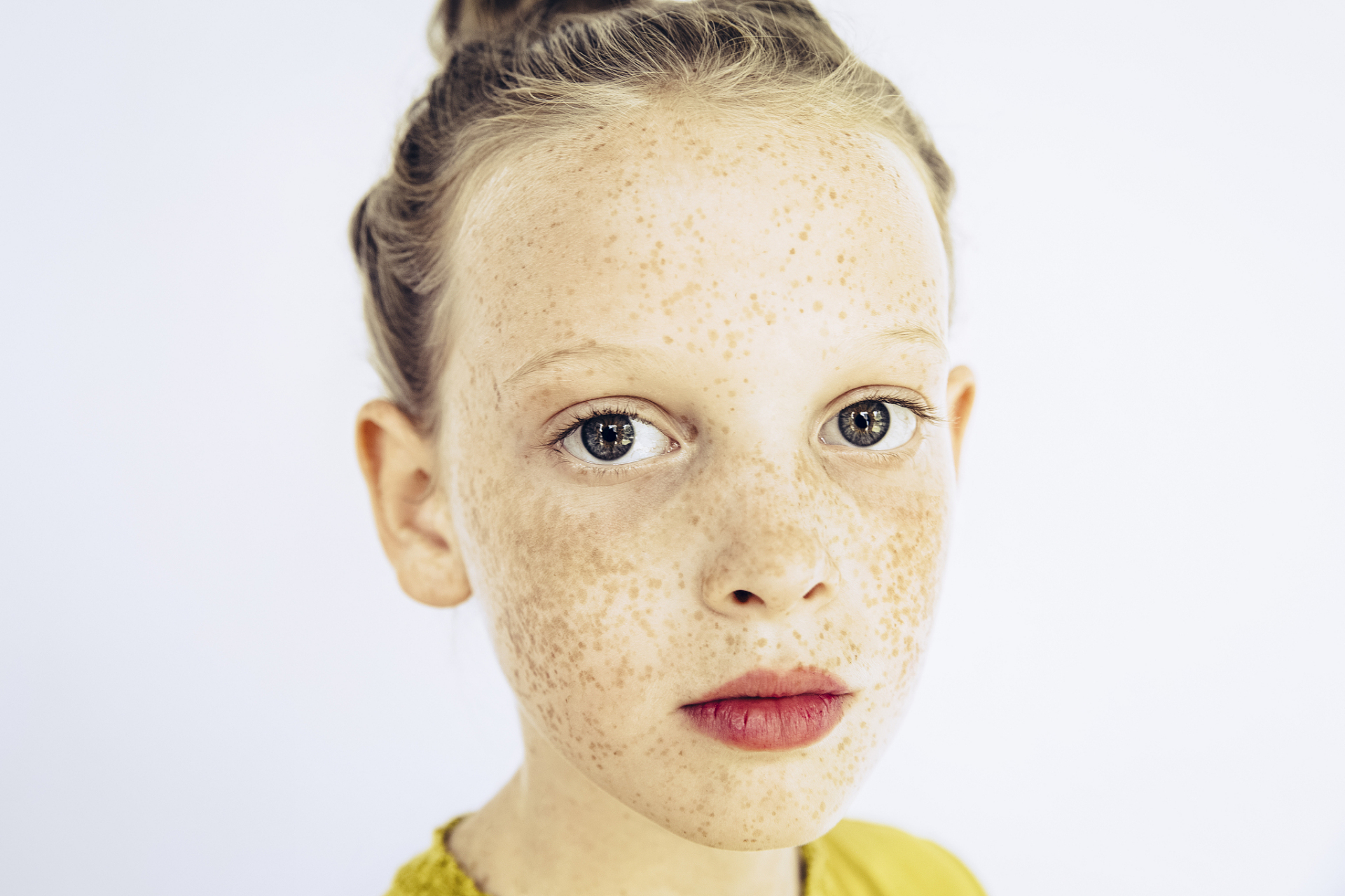 雀斑的成因与遗传,紫外线照射,内分泌等因素有关.