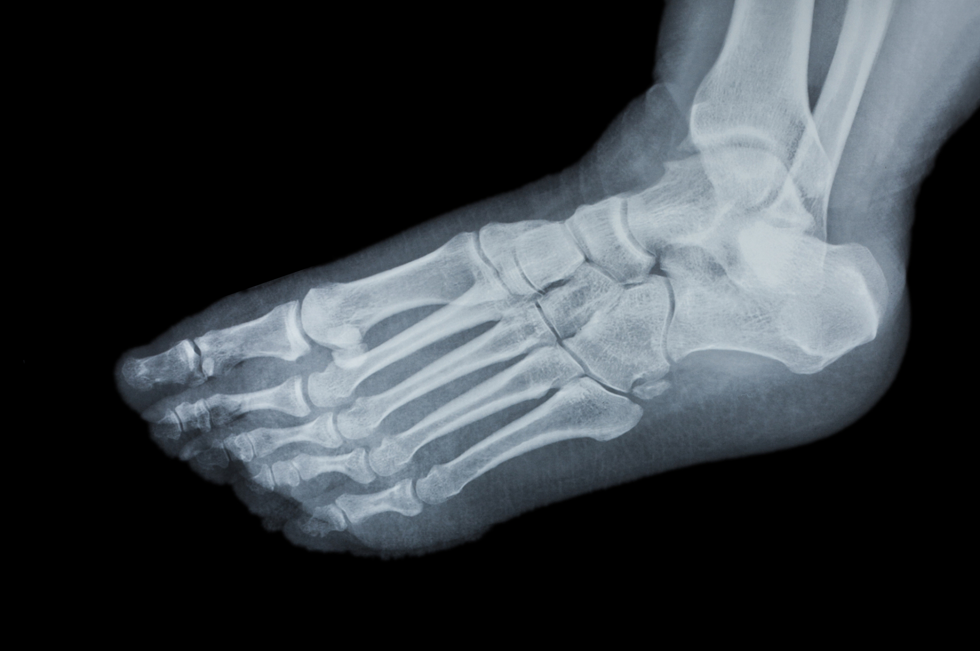 来听听骨科医生怎么说的】  常用踝关节骨折分型如下:  1,lange