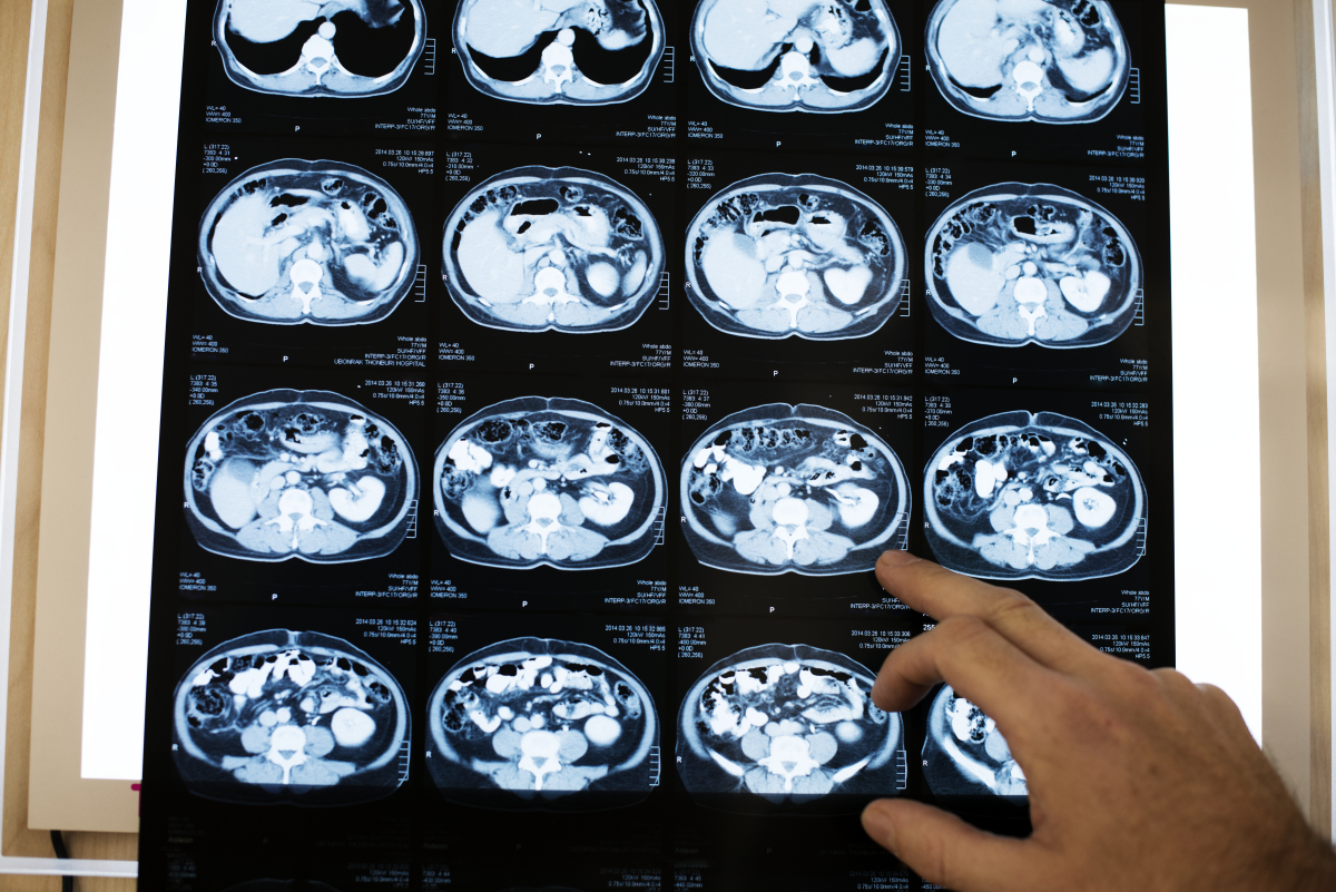 别让过度检查害了你肿瘤专家这些癌症不宜频繁接受ct扫描