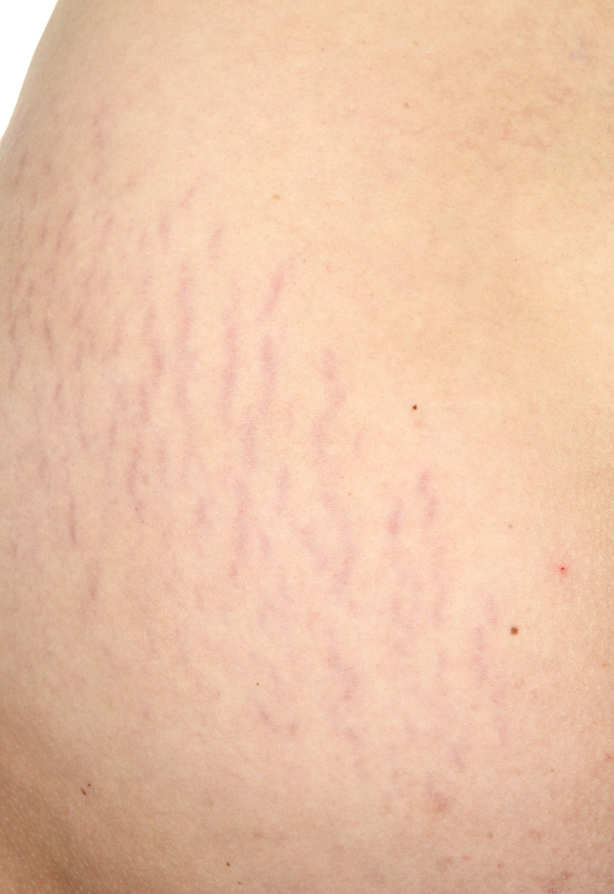 目前最有效祛除妊娠纹 #医美科普挑战赛# #医美#   目前最有效的祛除