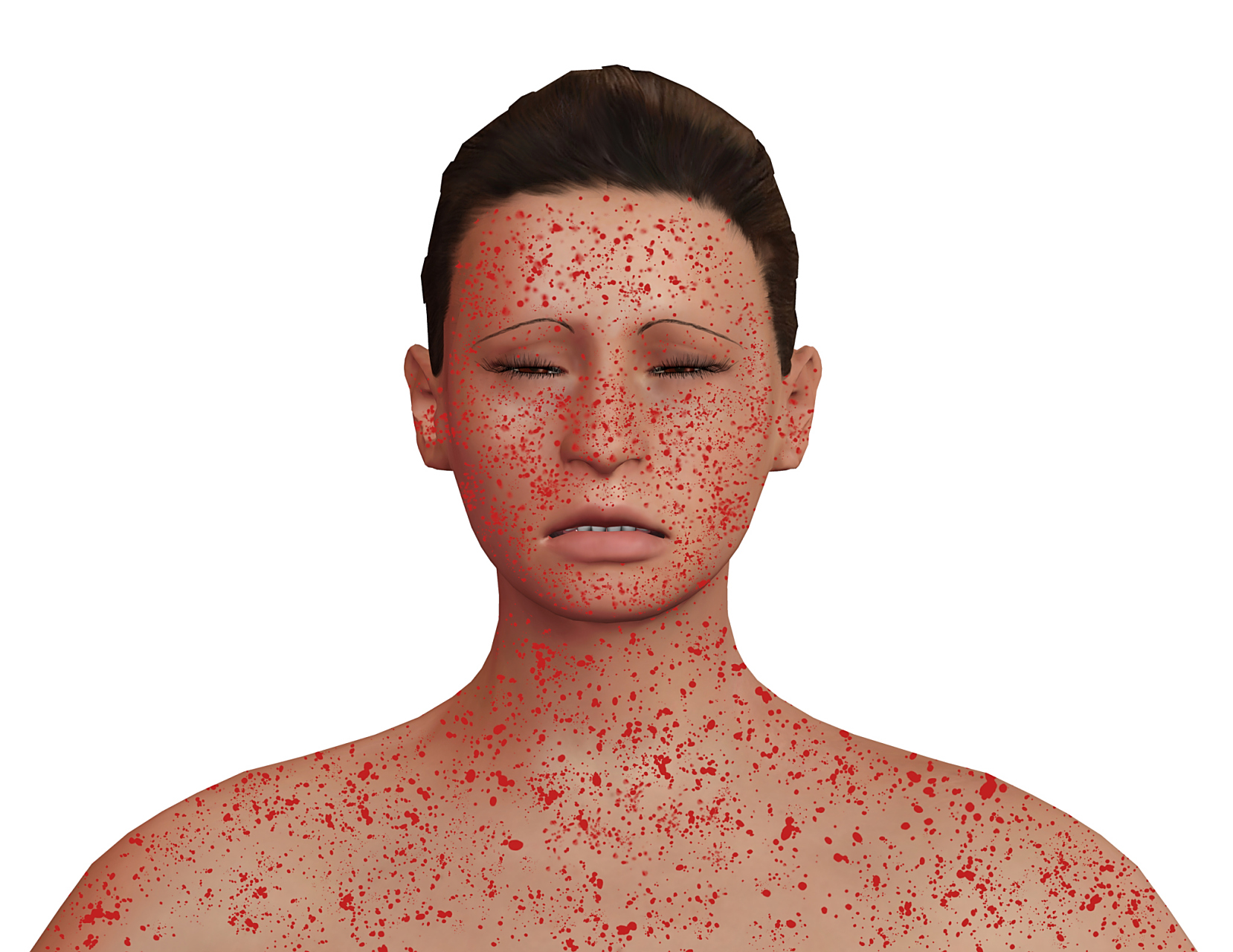 麻疹预防措施:守护健康的坚实屏障 麻疹是一种高度传染性的疾病,但通