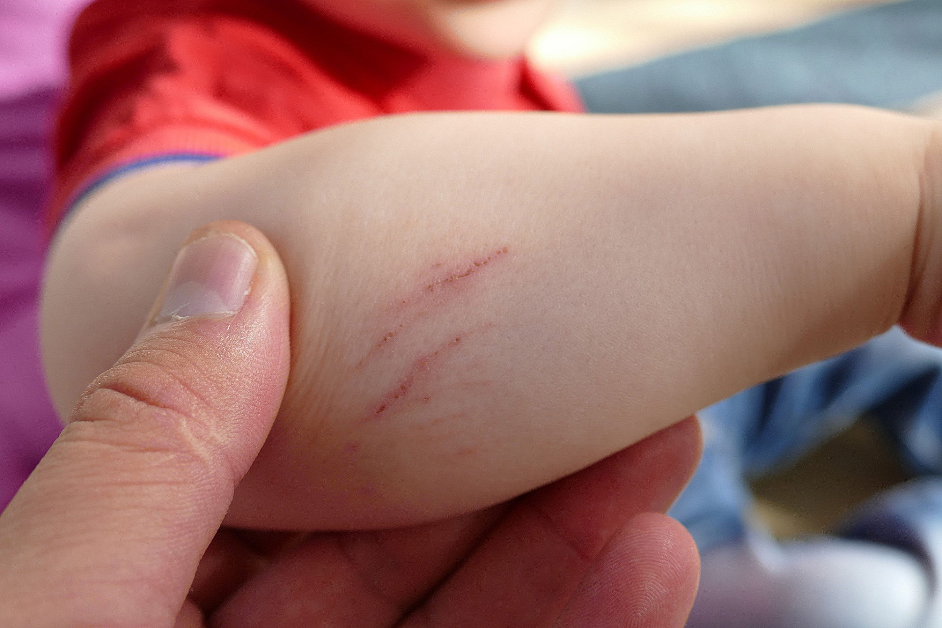 8岁孩子被小狗抓伤患狂犬病死亡# 【南宁一8岁孩