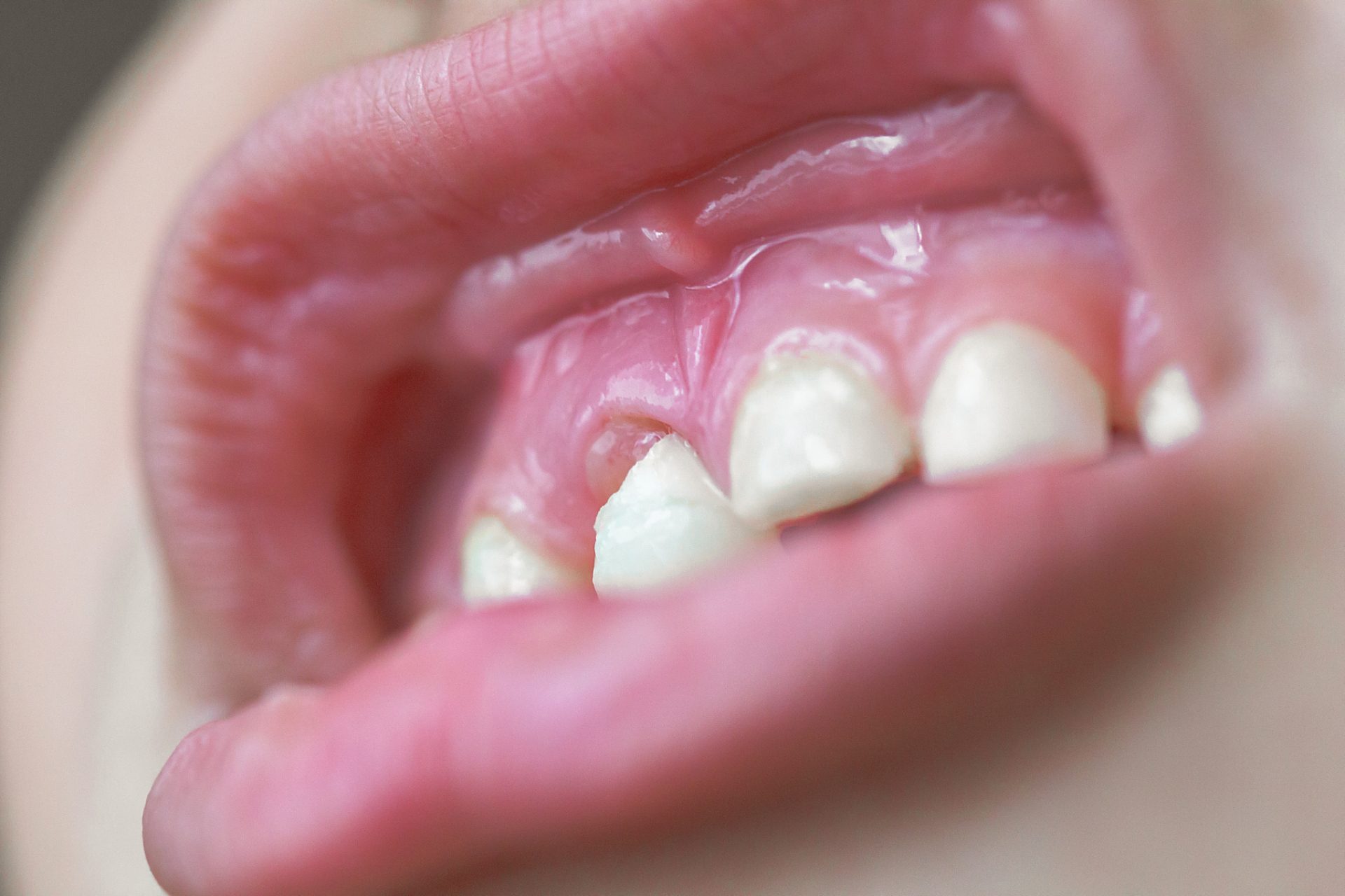 1,牙龈炎:儿童出现食物嵌塞或者用口呼吸,都容易诱发牙龈炎,在炎症