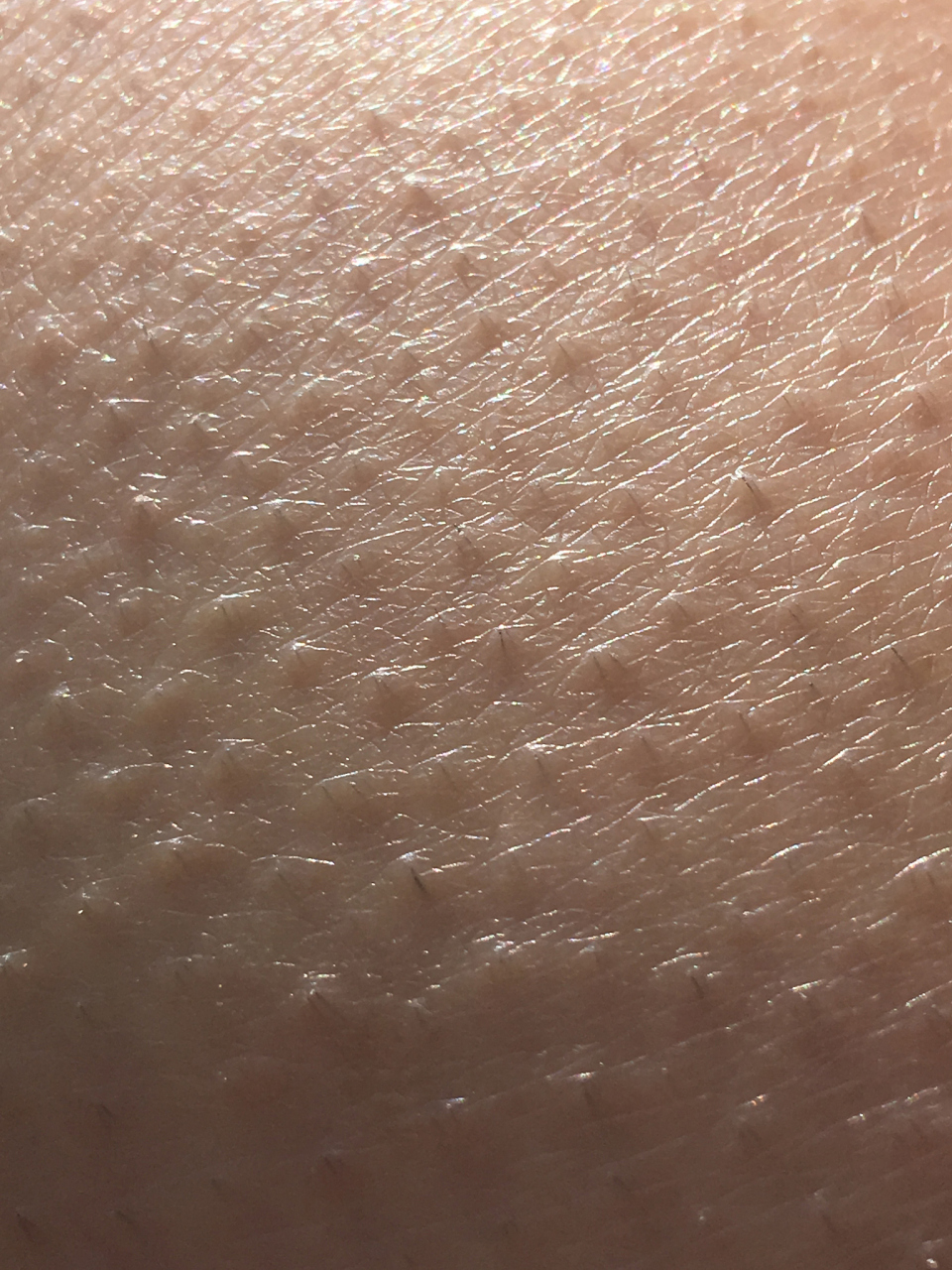 鸡皮肤怎么去除方法  身上的鸡皮肤去除方法可以采用