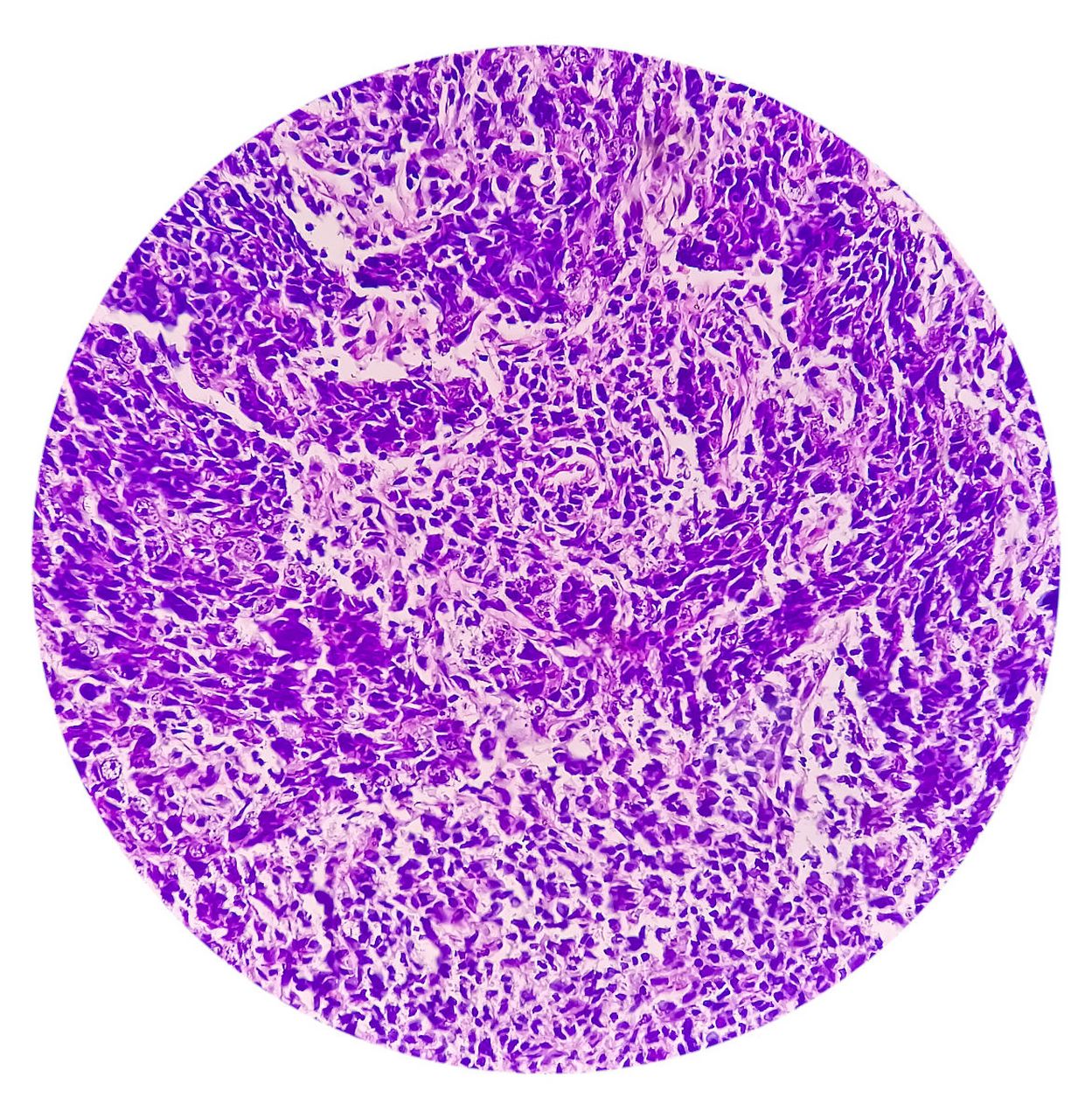 公公得了鼻咽癌,花光了自己的积蓄.