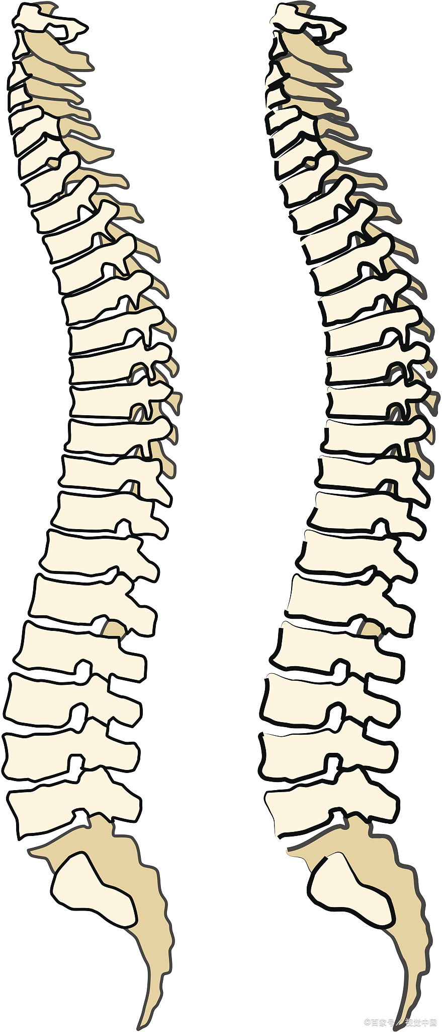 腰椎椎管狭窄,这一听就让人头疼的病症,常常让患者饱受疼痛折磨