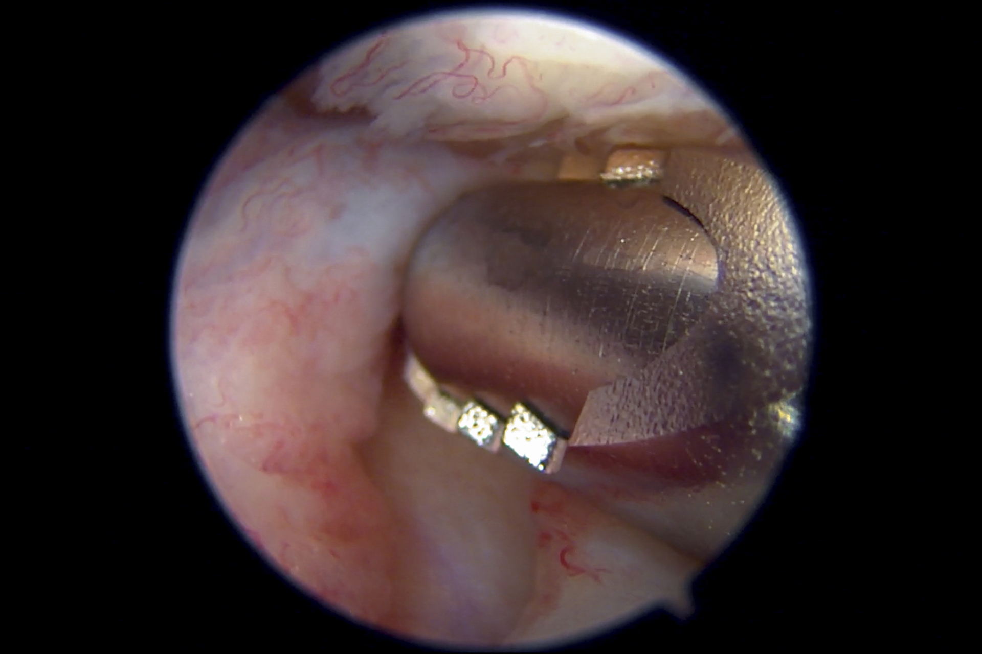 鼻孔里有个肉疙瘩 您发现自己的鼻子一个或者两个鼻孔内有个小肉疙瘩