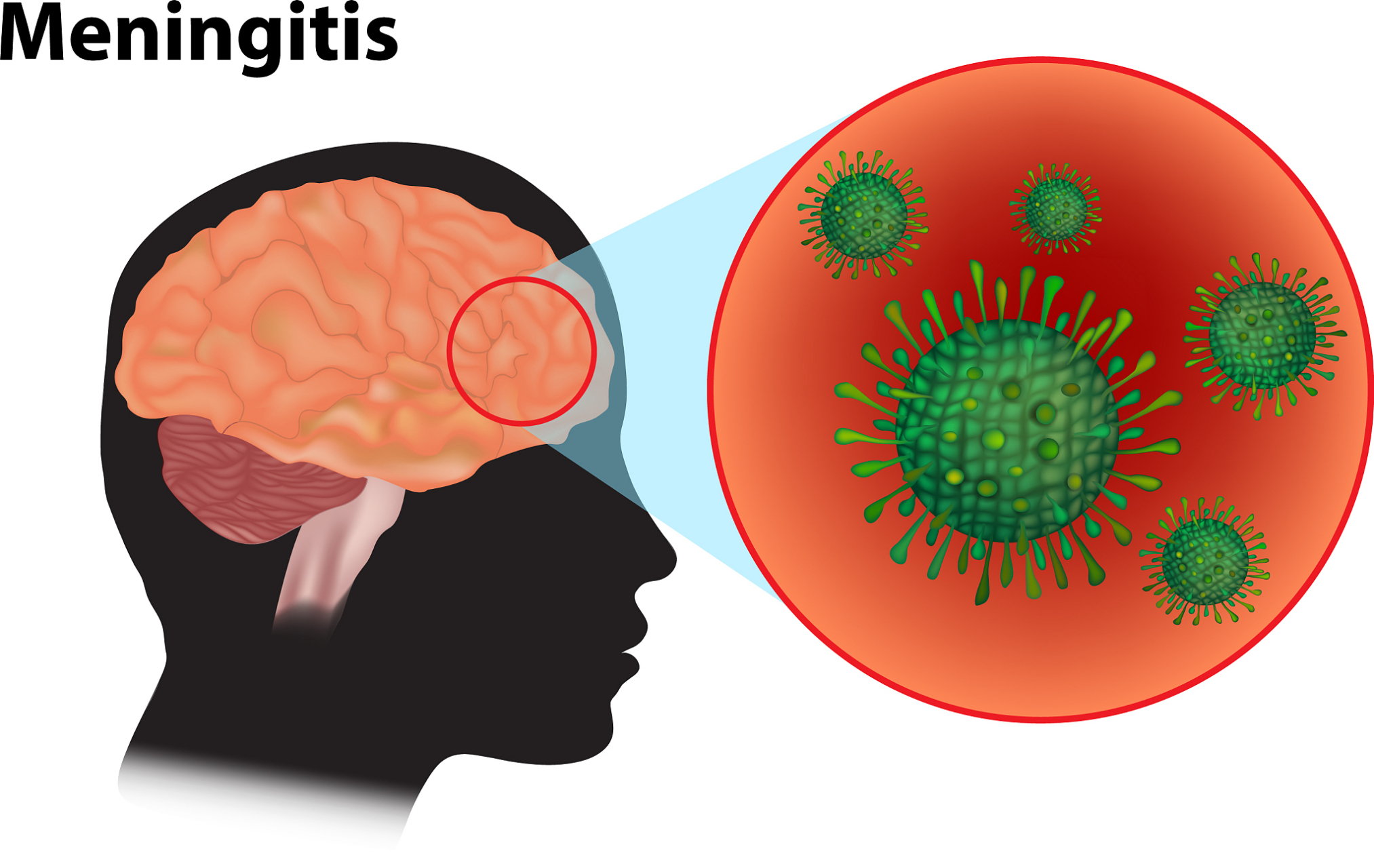 儿童脑膜炎:预防,早期诊断和治疗 儿童脑膜炎是一