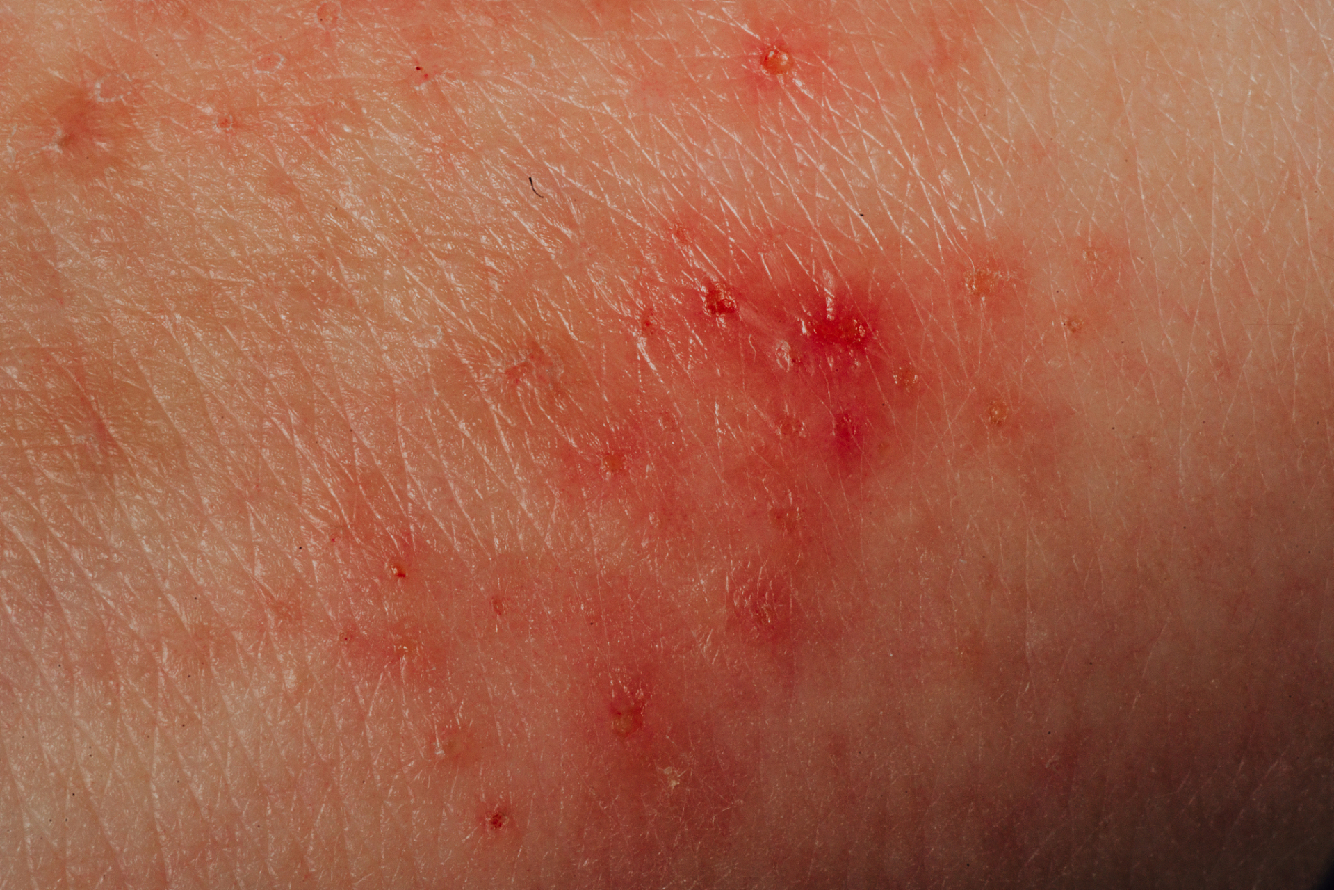 皮炎和湿疹有什么区别?