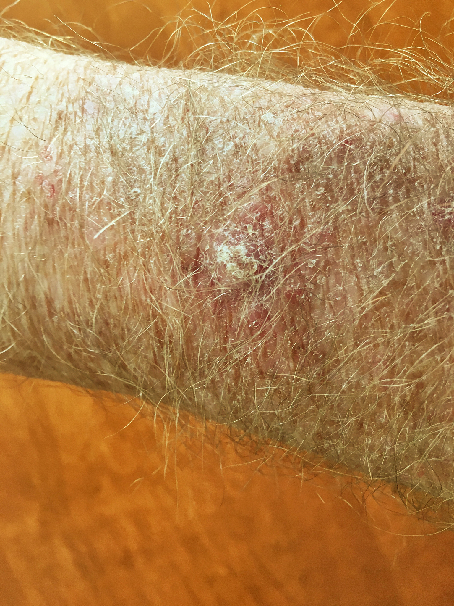 夏季防晒,避免皮肤日晒伤问题