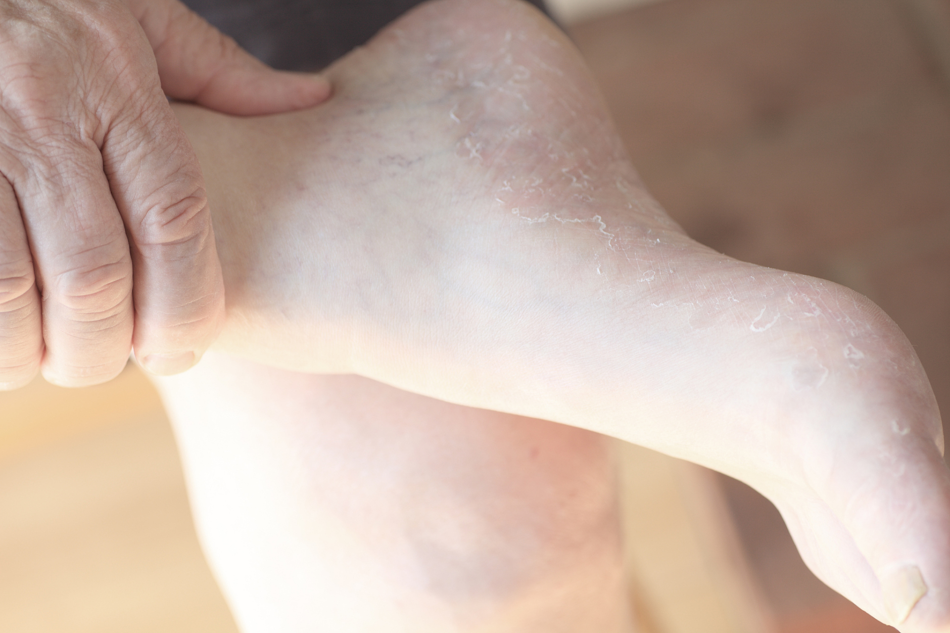 怀孕了脚上起小水泡痒怎么办  最近,我的诊所来了一位名叫李女士的