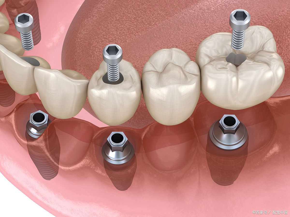 严格的质量控制的种植体,它是一种用于牙齿缺失患者的重要修复方式