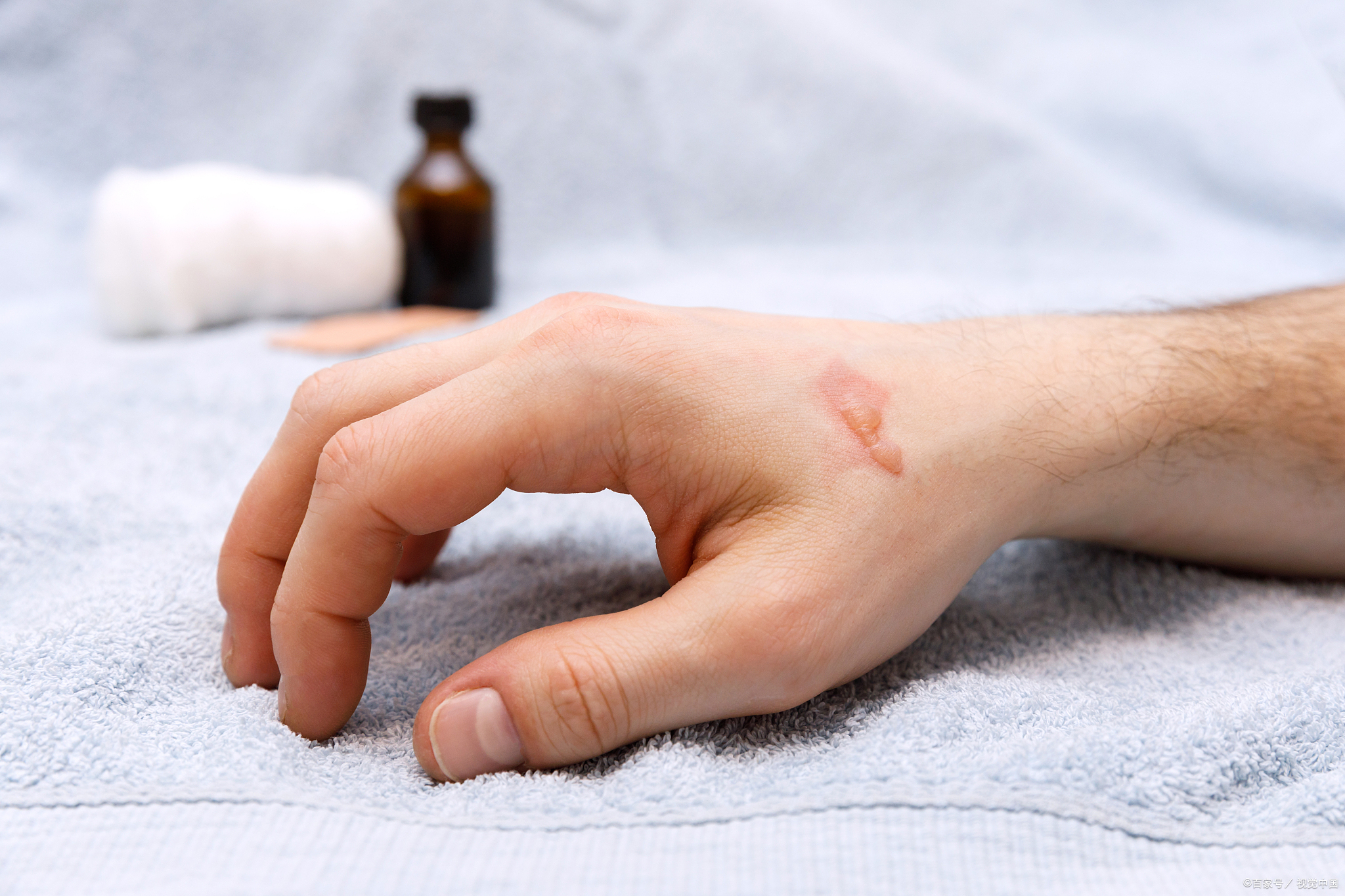 烫伤水泡扎破会留疤吗?