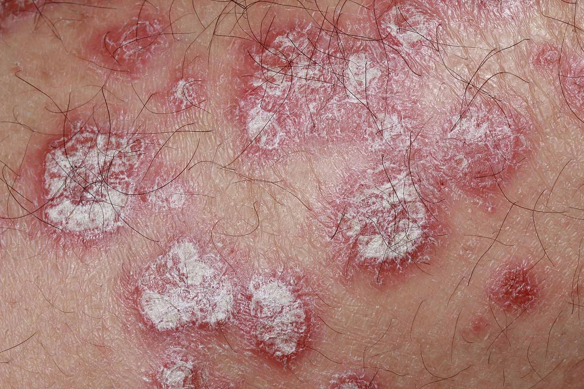 银屑病皮肤表面会形成一层一层的银白色鳞屑,有的患者啊经常是控制不