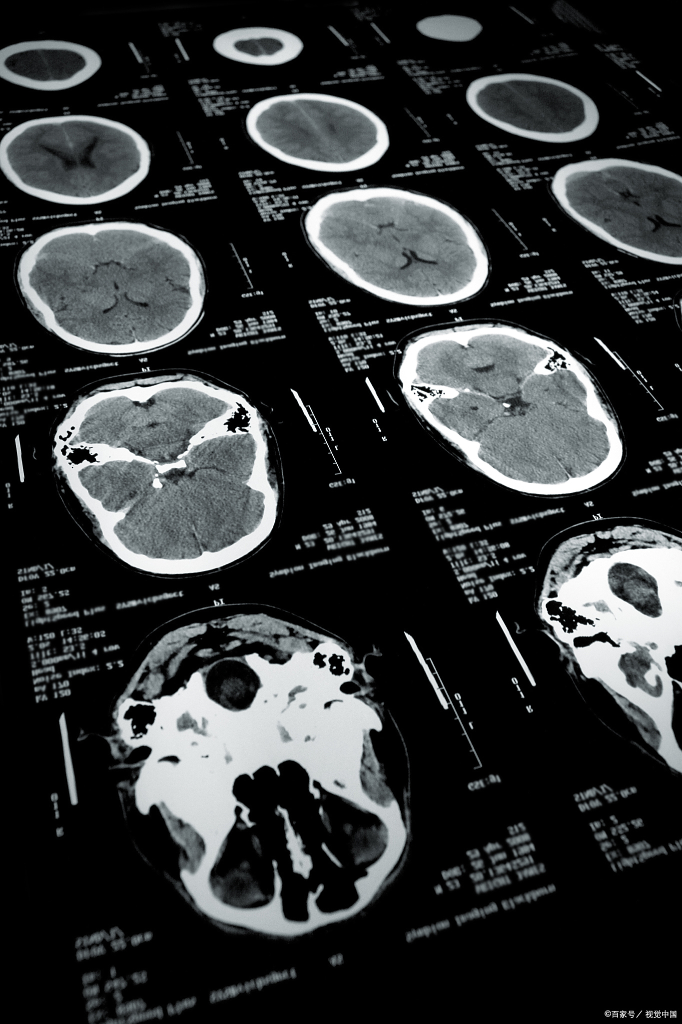 脑囊肿需要手术吗?