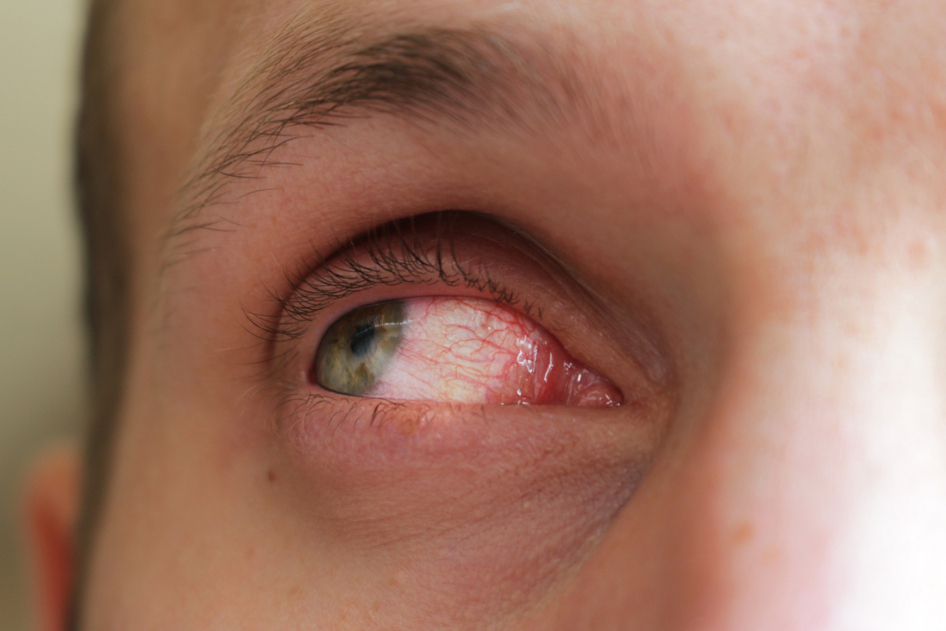 结膜炎&角膜炎71不要再傻傻分不清了75  结膜炎(conjunctivitis)