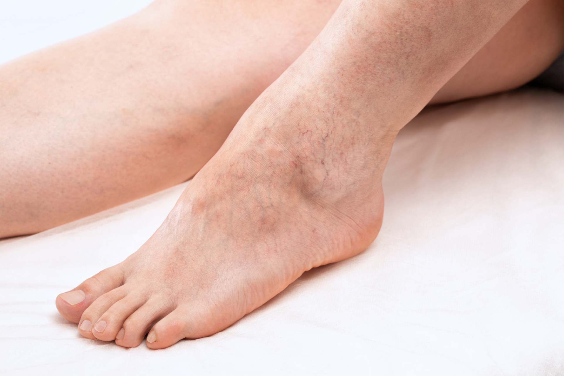 化疗性静脉炎不容小觑,我来支一招 1,马铃薯片 将新鲜马铃薯洗净,切成