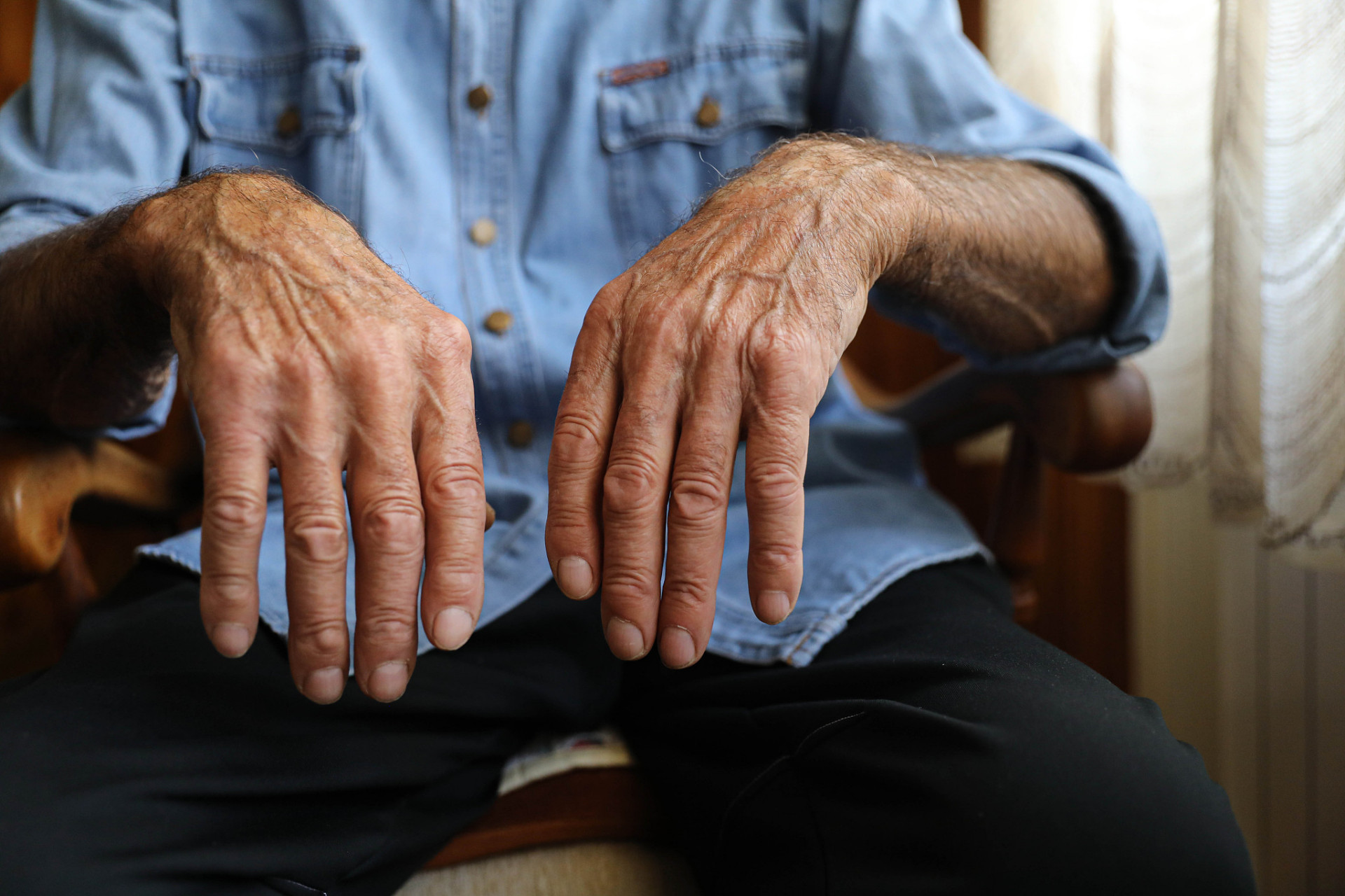 "渐冻症",也被称为肌萎缩侧索硬化症(als),是一种罕见的神经系统