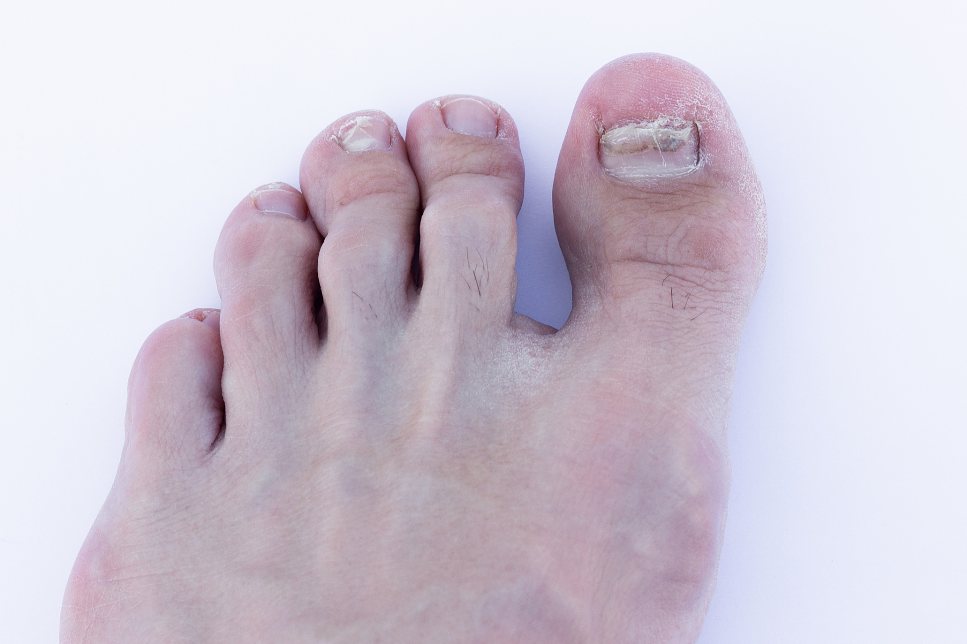 "那么本期就为大家讲解一下,为什么会出现糖尿病患者脚趾变白的