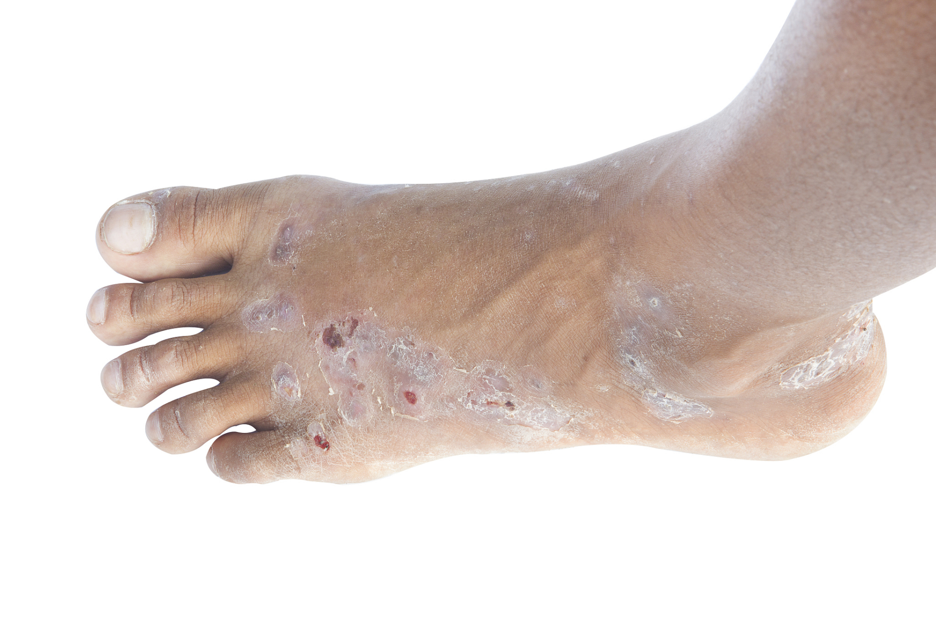 以下是一些预防足癣感染的方法:  保持脚部清洁和干燥:经常用温水和