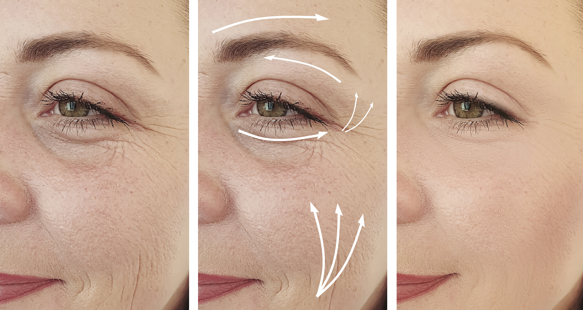 眼纹特别深怎么办才能消除  眼纹特别深可以通过以下几种方式进行处理