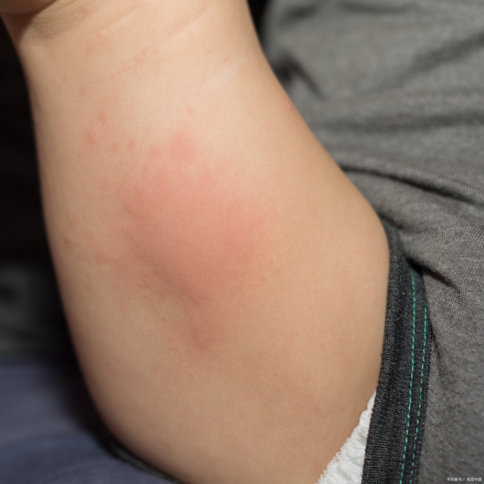 从病因上看,过敏是身体对特定物质,像花粉,食物,尘螨等过度反应