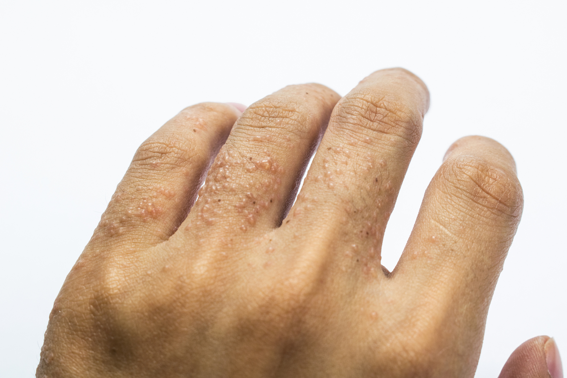 如何预防急性湿疹发作呢?    首先,你有没有留意过你的生活习惯?