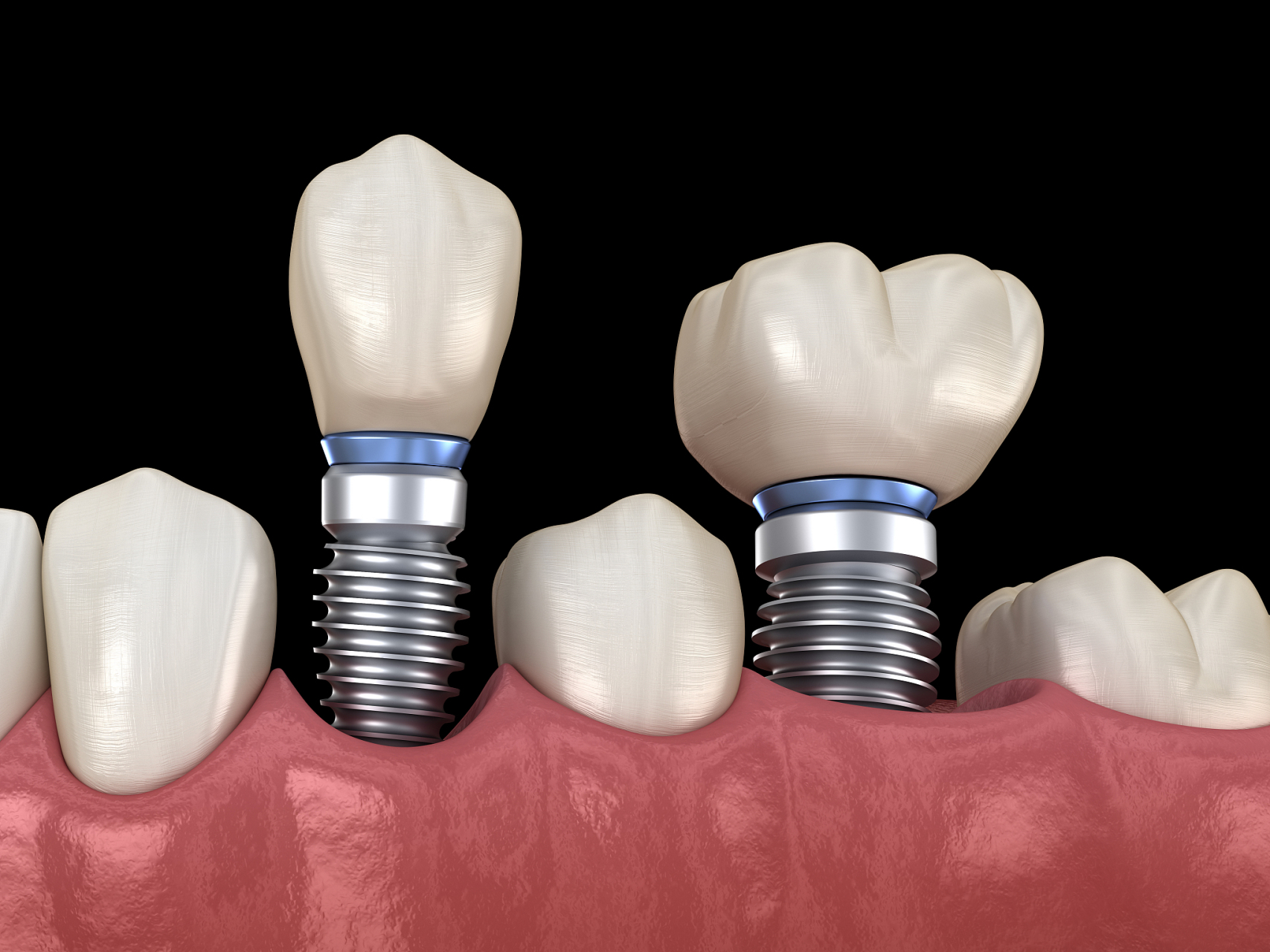 种植牙材料怎么选的?有亚洲品牌不能选,欧美品牌好的说法吗?