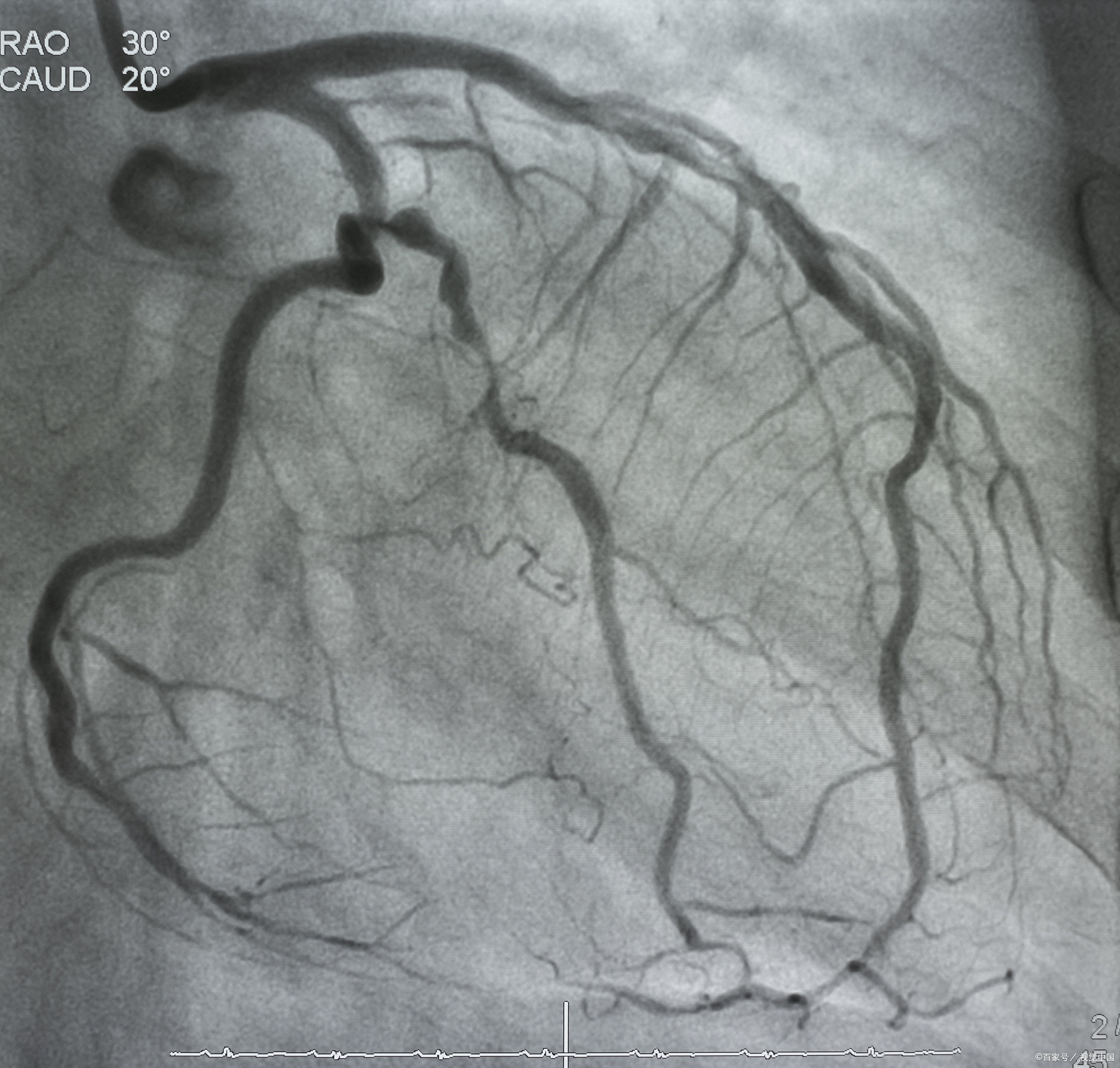 冠状动脉造影图详细图图片