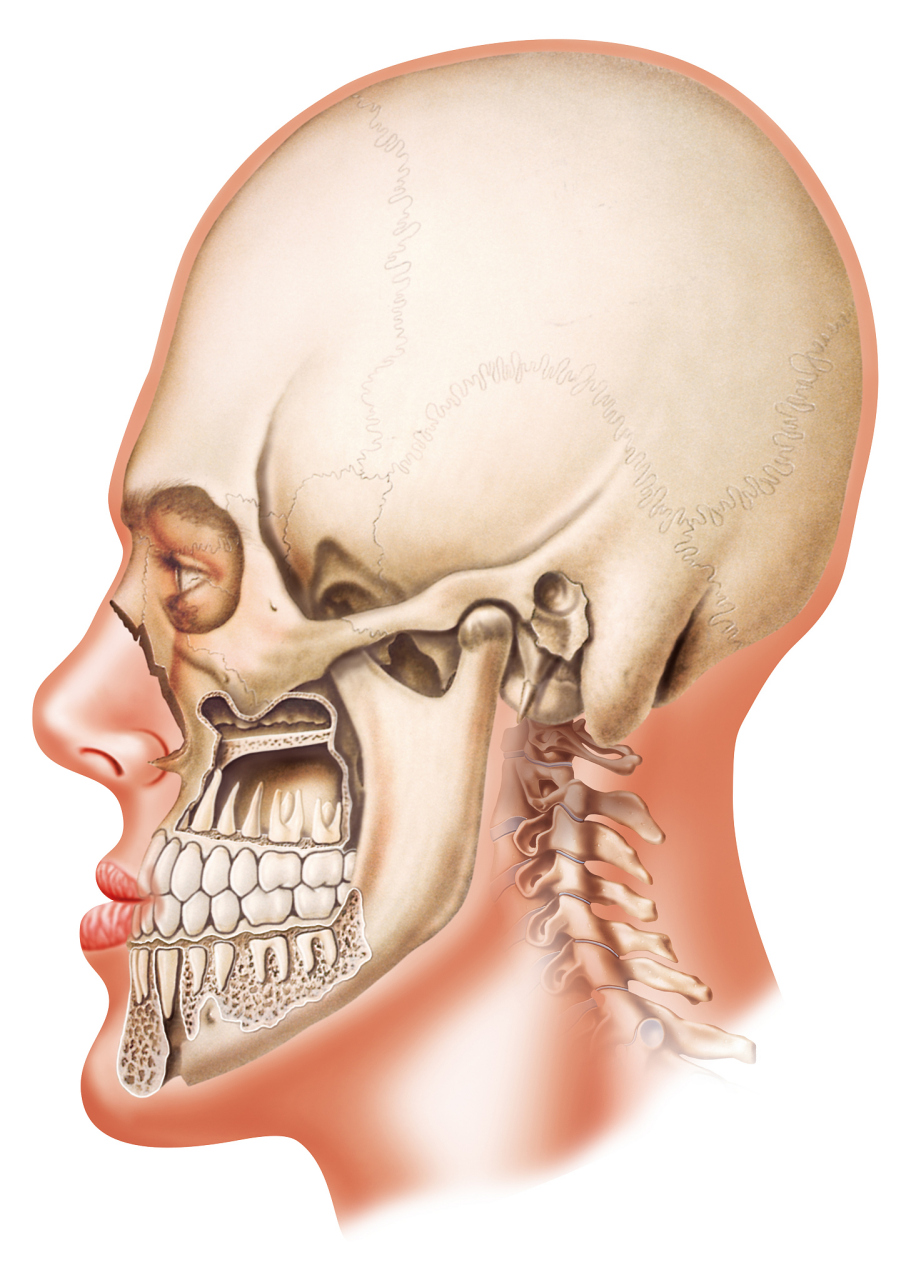 反颌是什么  反颌是一种颅颌面畸形,也称为下颌后缩.