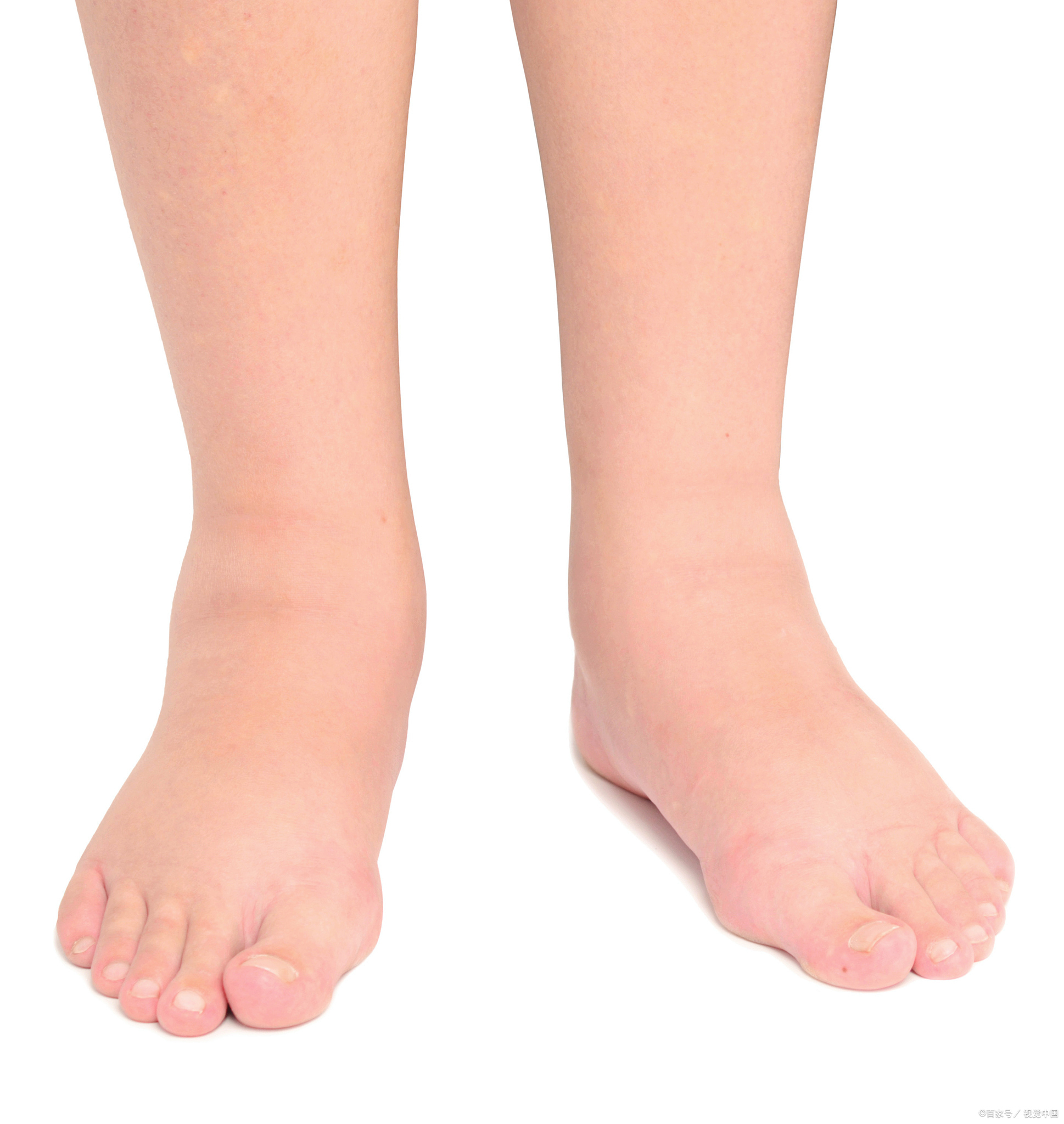 肾衰竭来临总是"不声不响"?