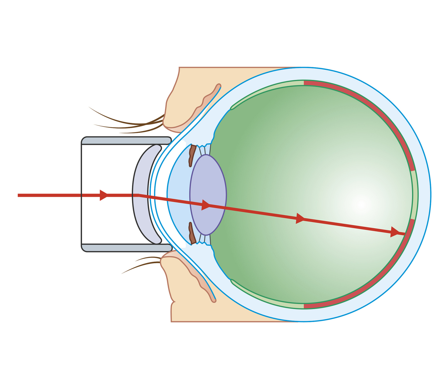 屈光参差症状表现为双眼视力存在差异.