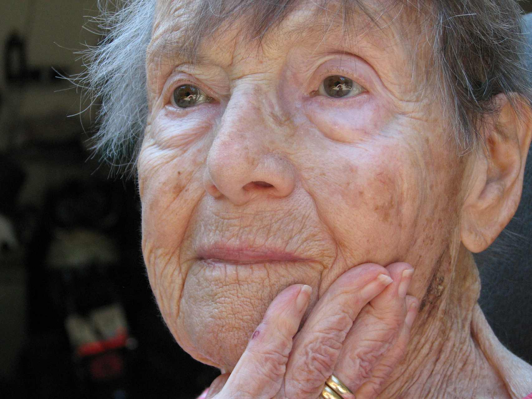 老年斑可以用激光去除吗  老年斑是老年人皮肤上常见的色素斑,通常是