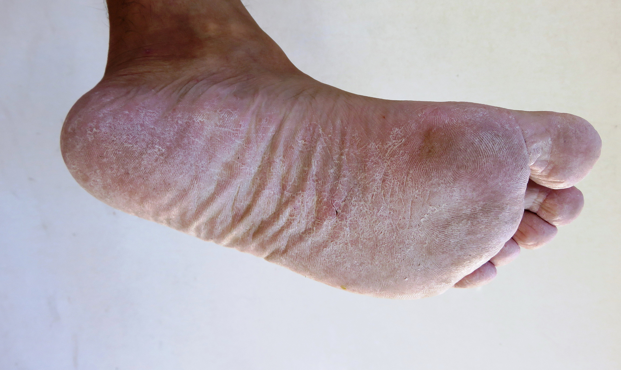 脚部真菌感染的症状图片