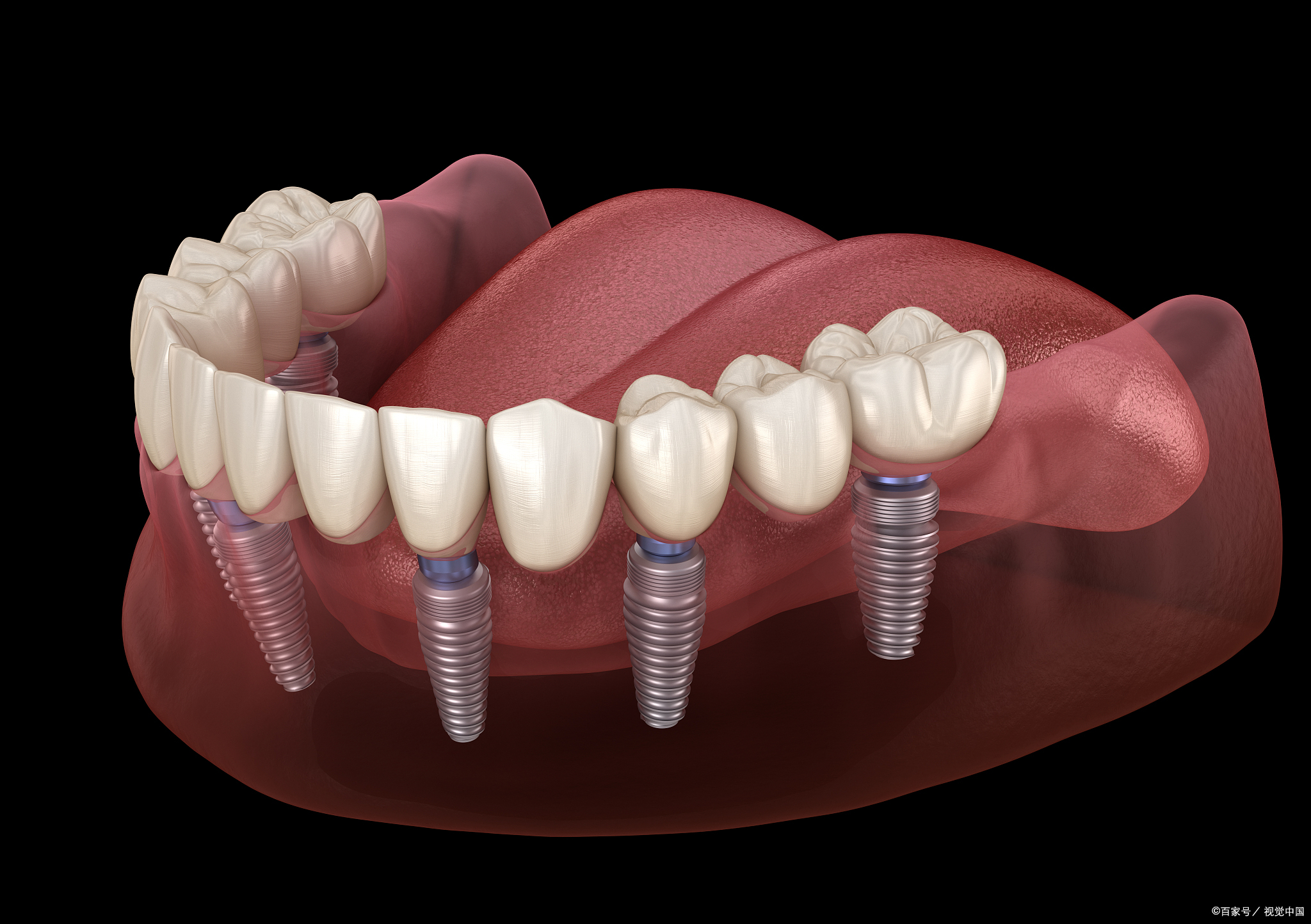 全口种植牙通常无法完全保证终身使用