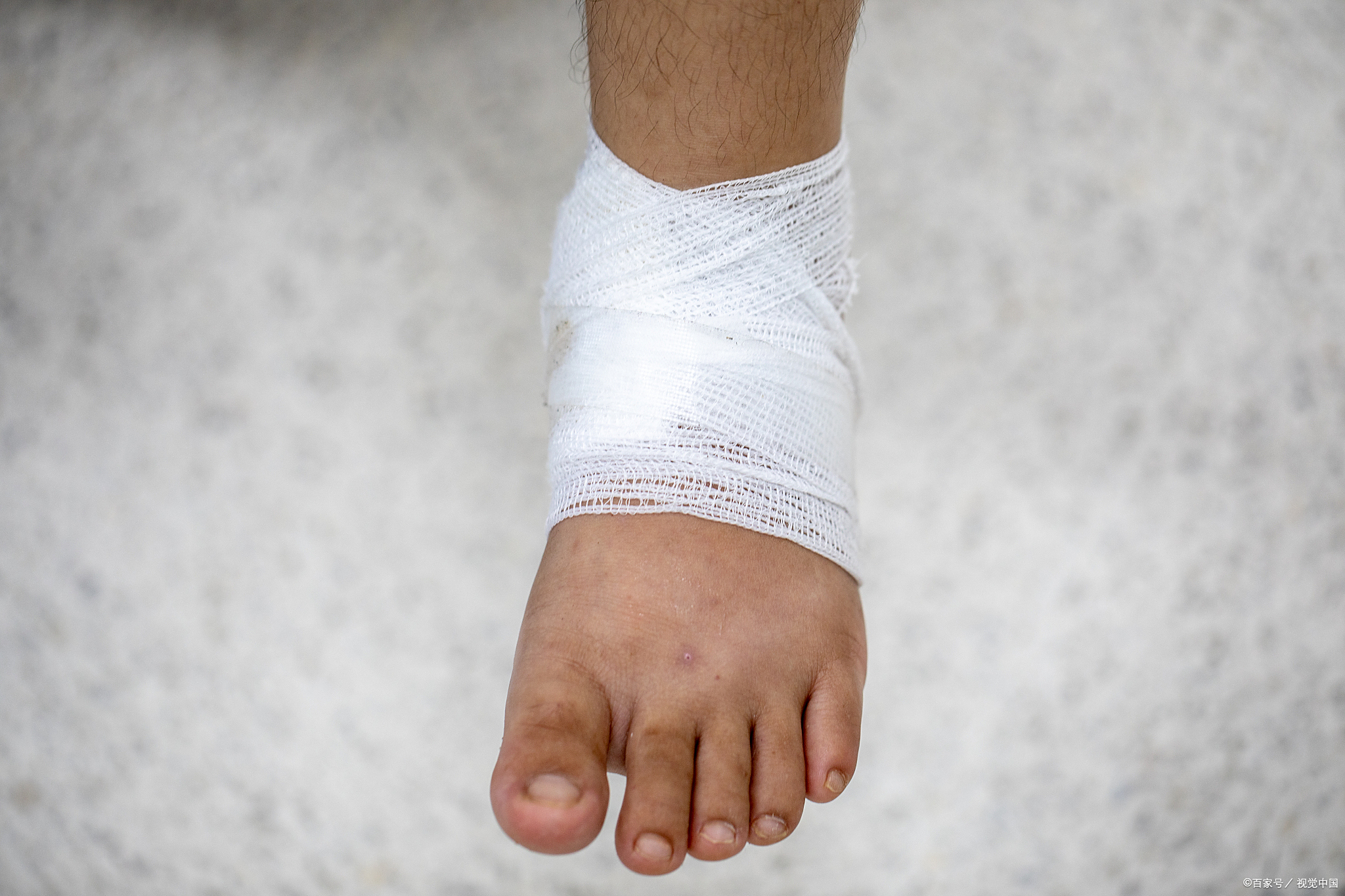 休息与抬高 扭伤后应立即停止活动,避免受伤部位进一步受到损伤