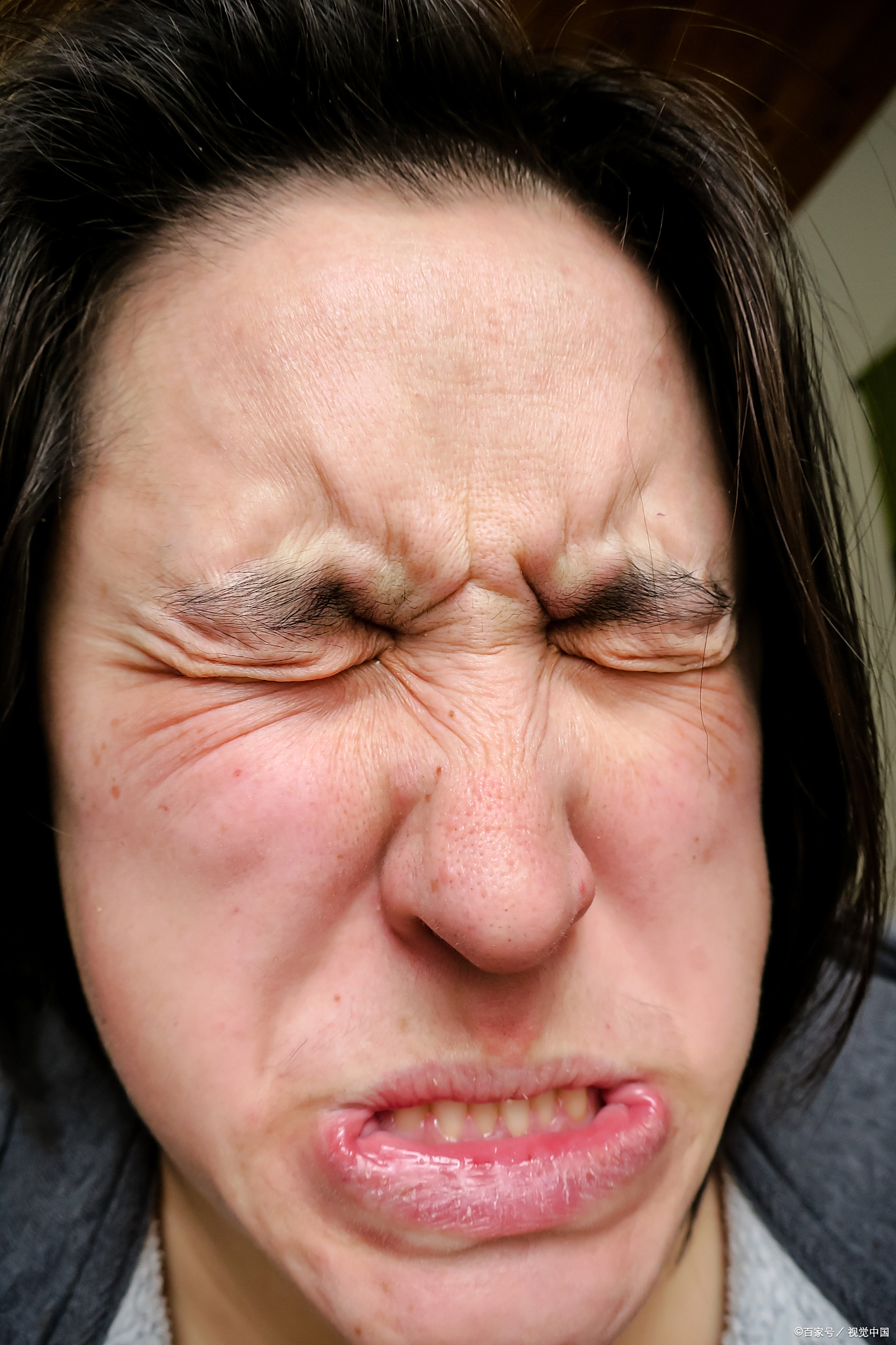 眼皮跳未必是面肌痉挛