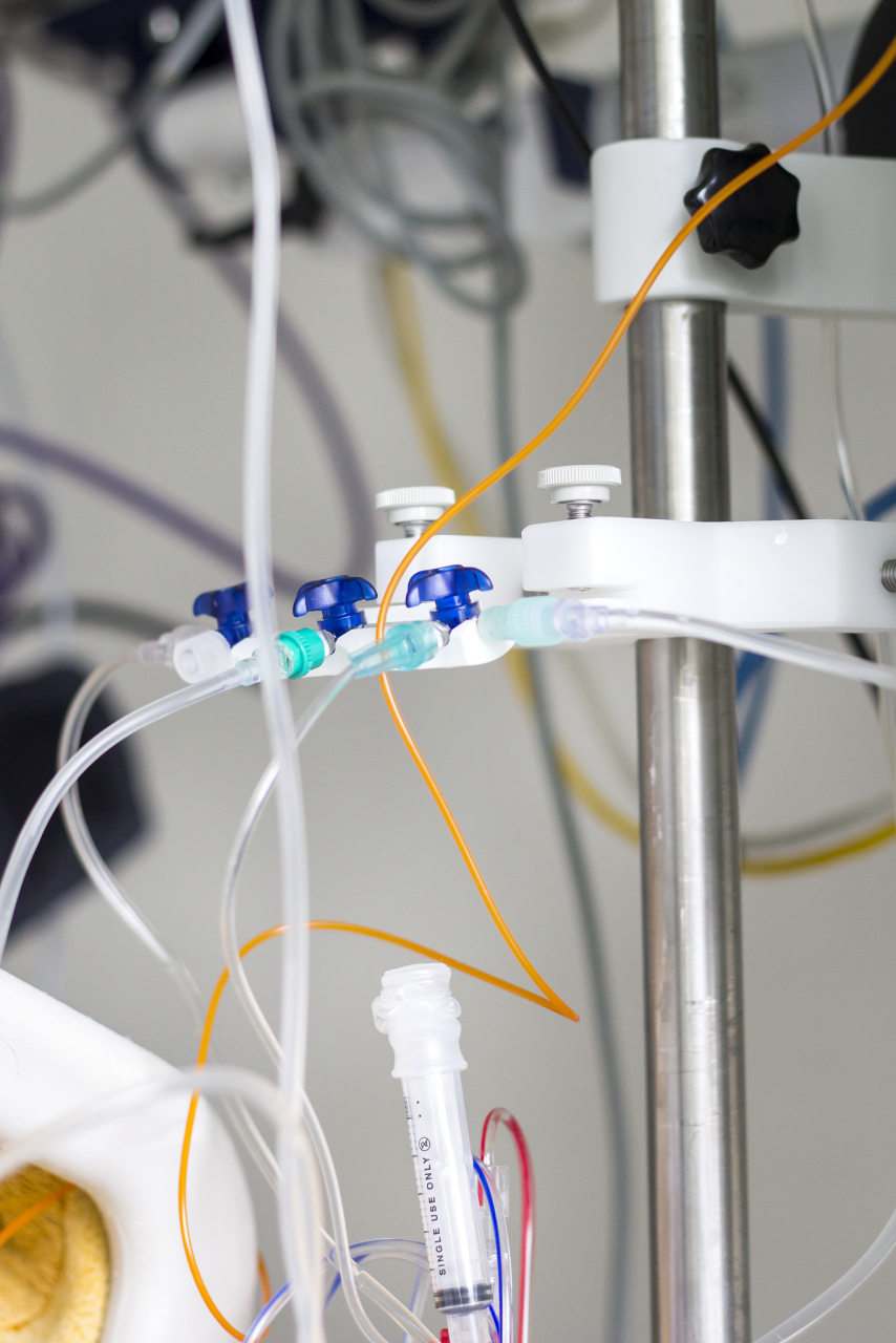 一个无辜的婴儿,血管中竟被留置针导管困扰长达五年之久!